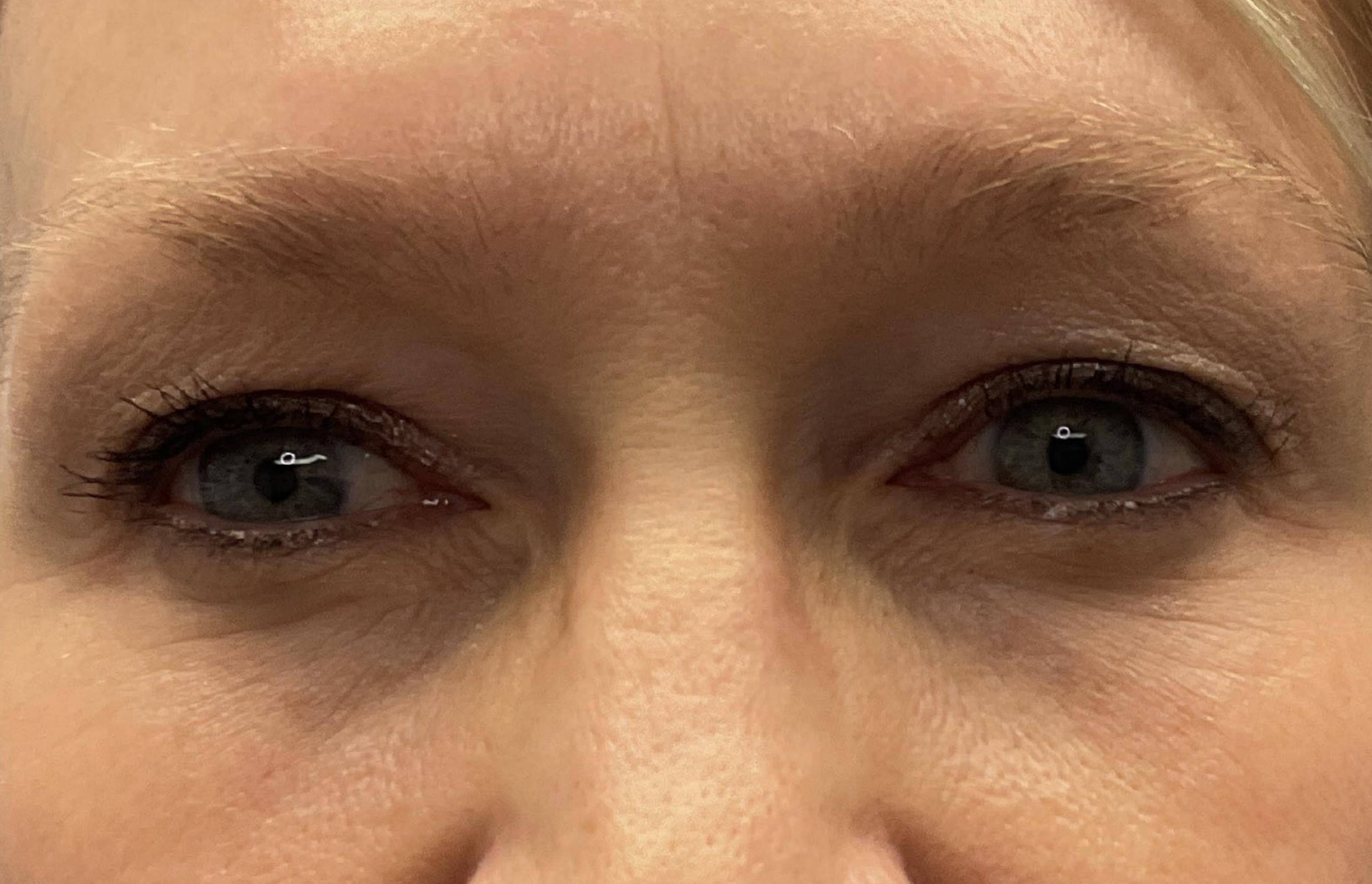 Blepharoplasty 7 - Upper Before