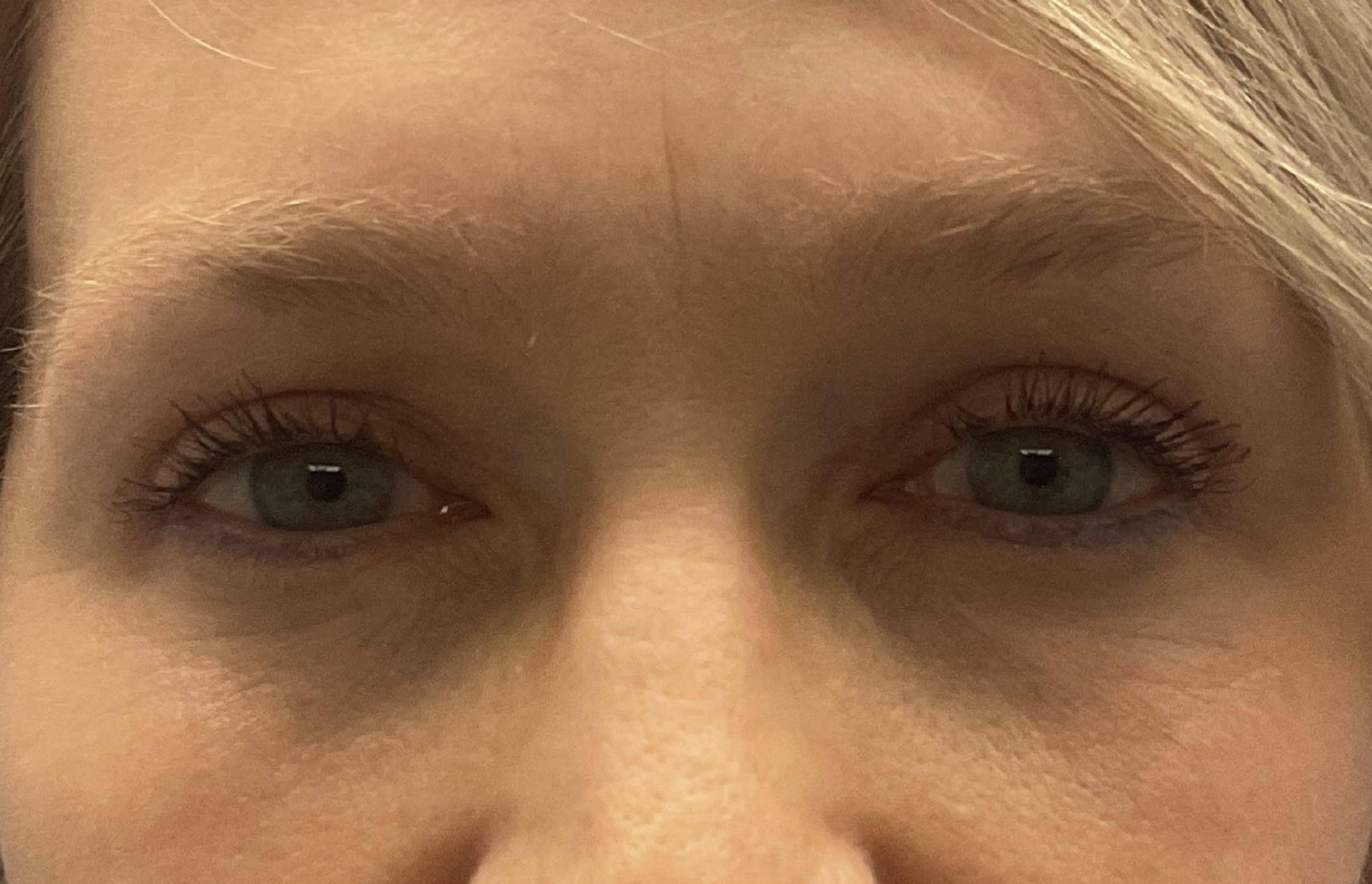 Upper Blepharoplasty 5 After