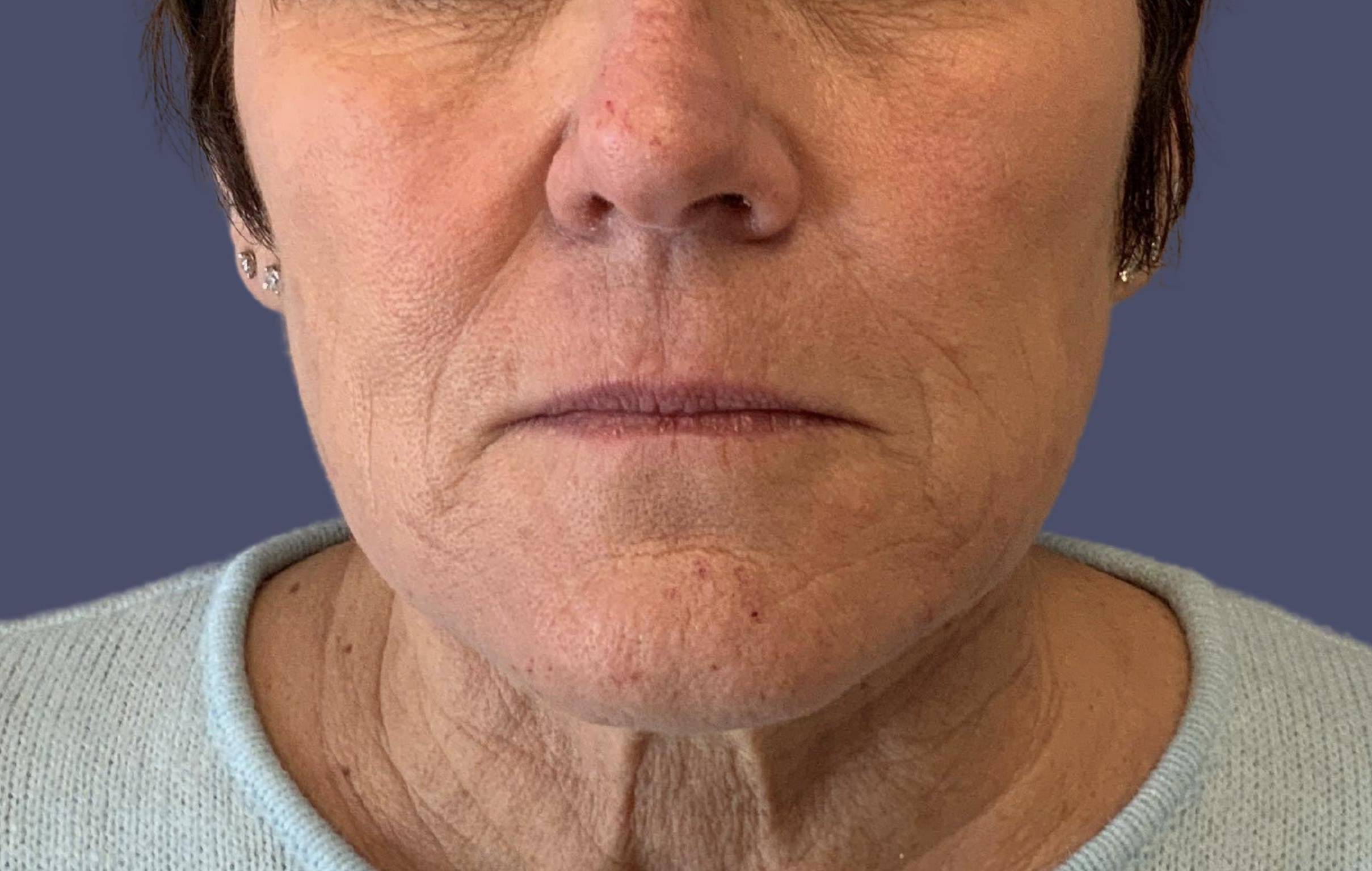 Dermal Fillers 9 - Nasolabial Folds, Mental Crease, & Lips Before