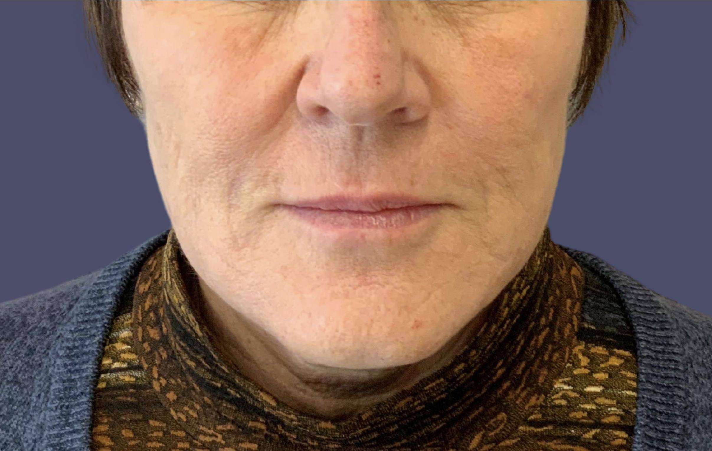 Dermal Fillers 9 - Nasolabial Folds, Mental Crease, & Lips After