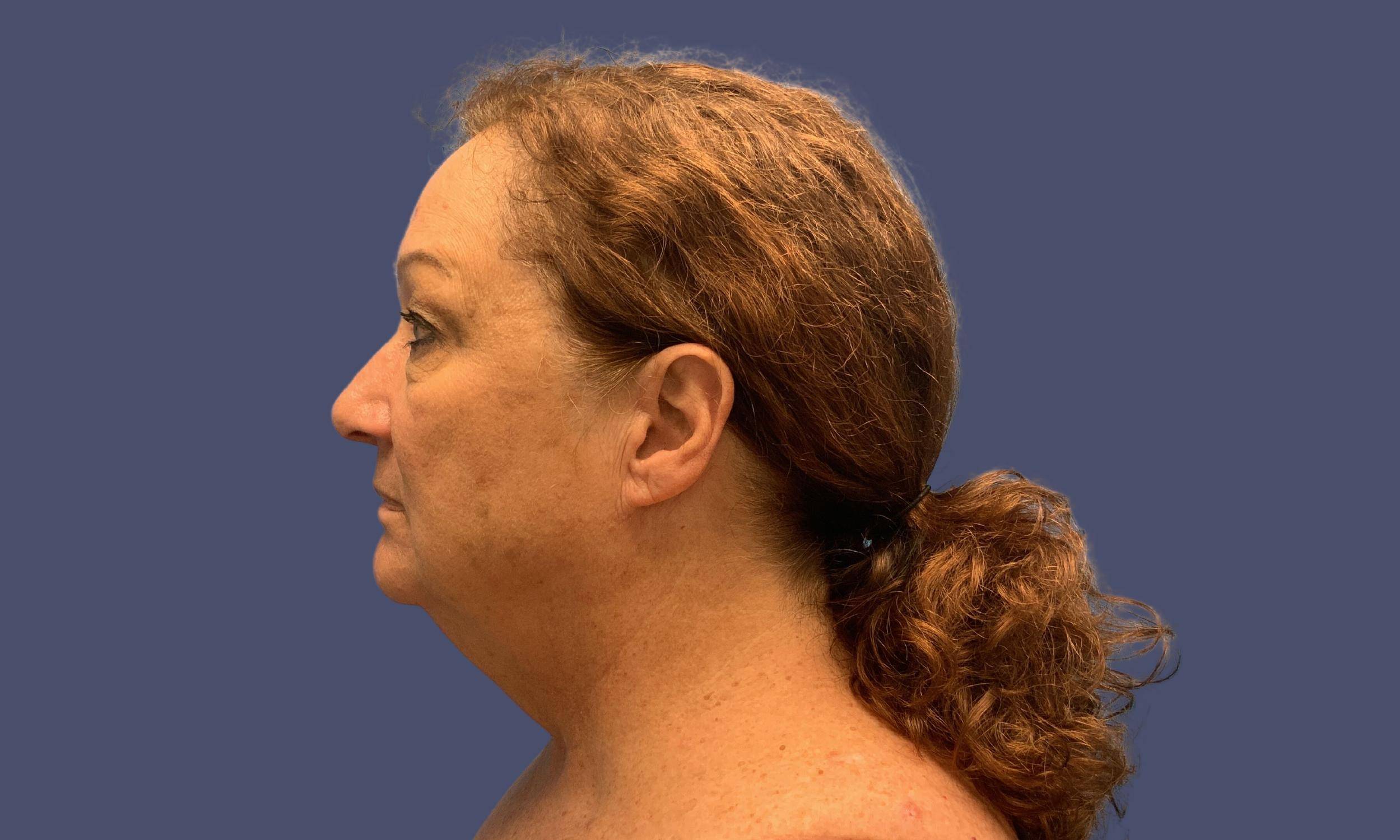 Facelift 2 Before