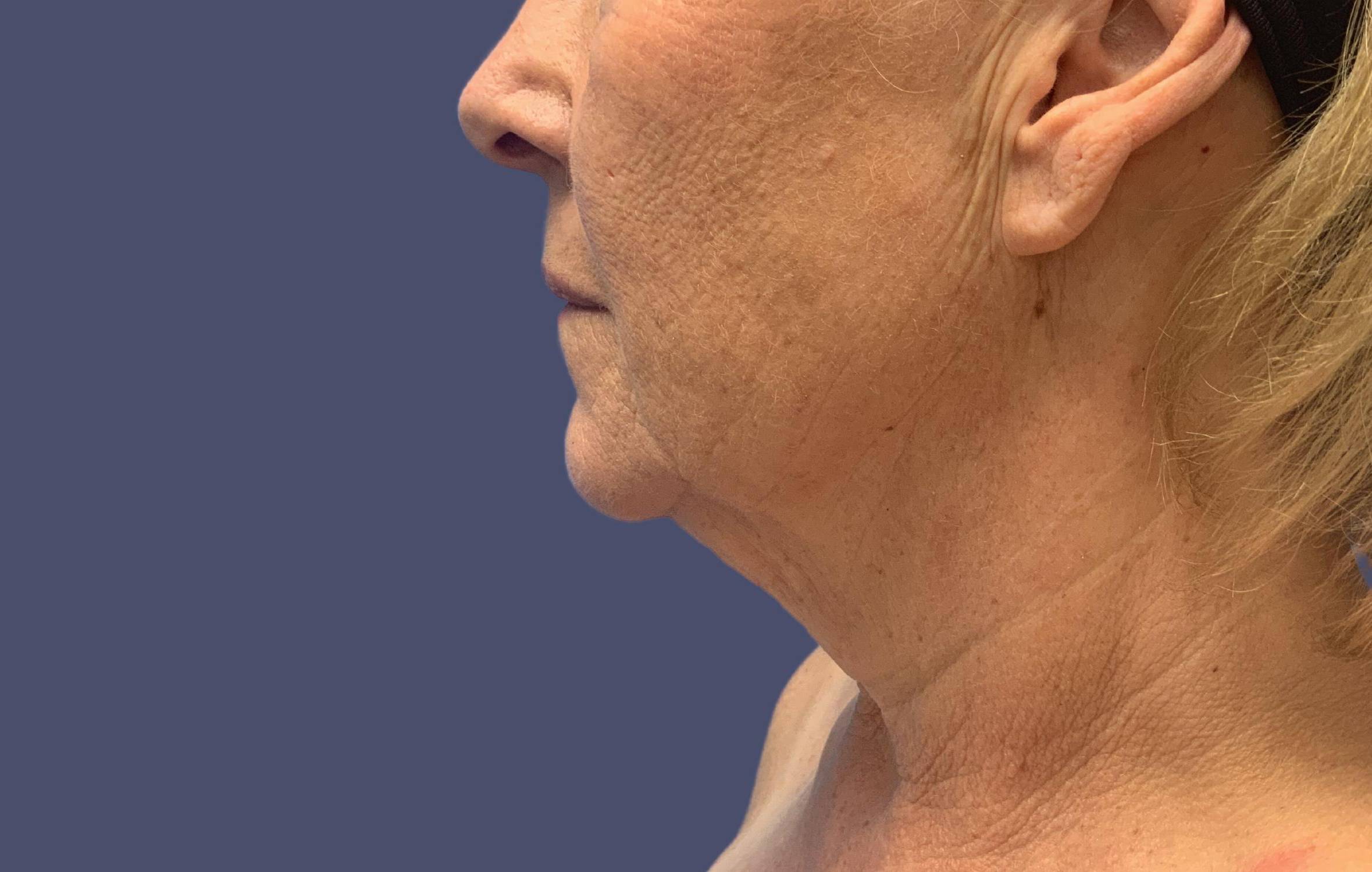 Necklift 1 Before