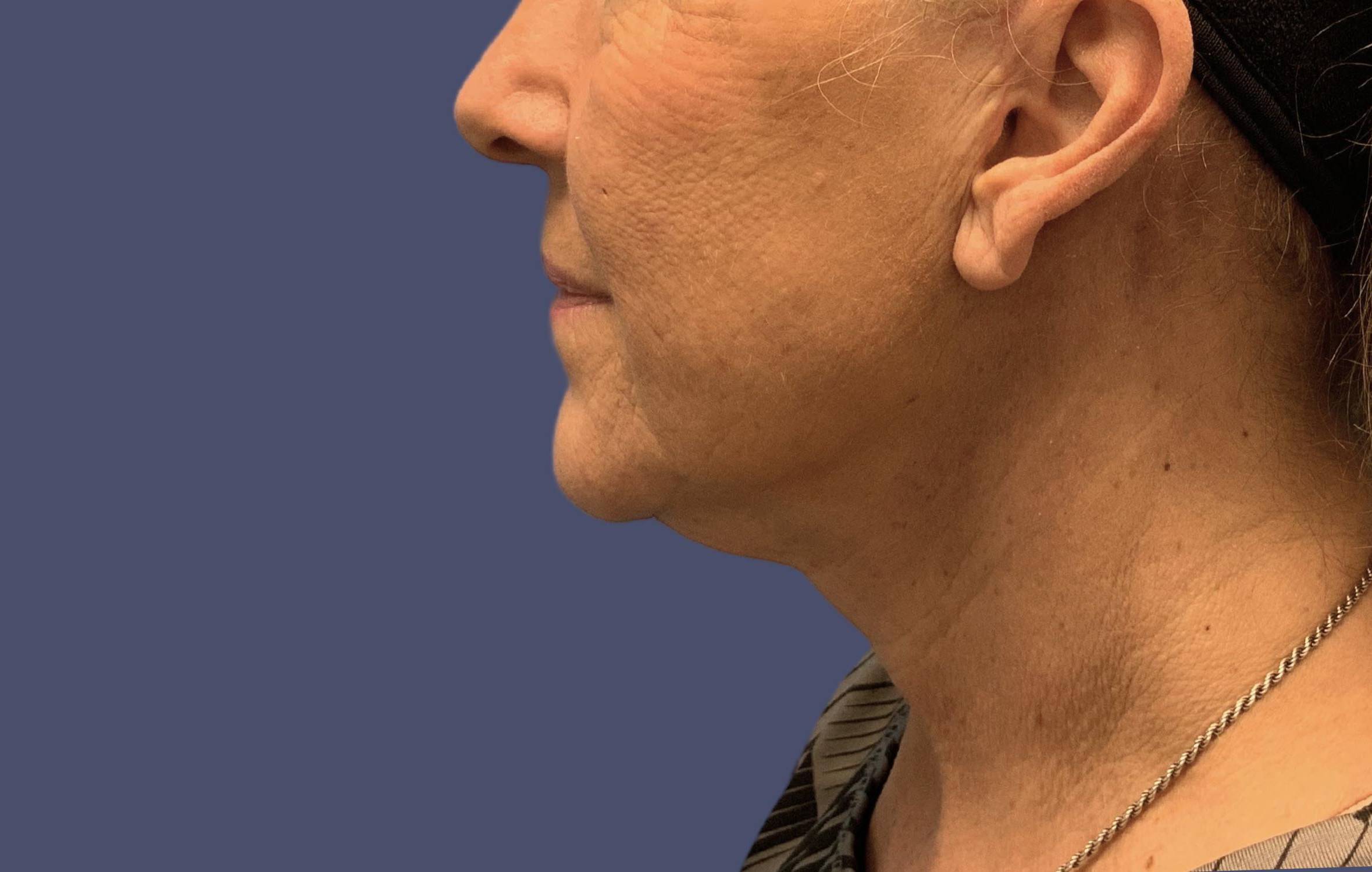 Necklift 1 After