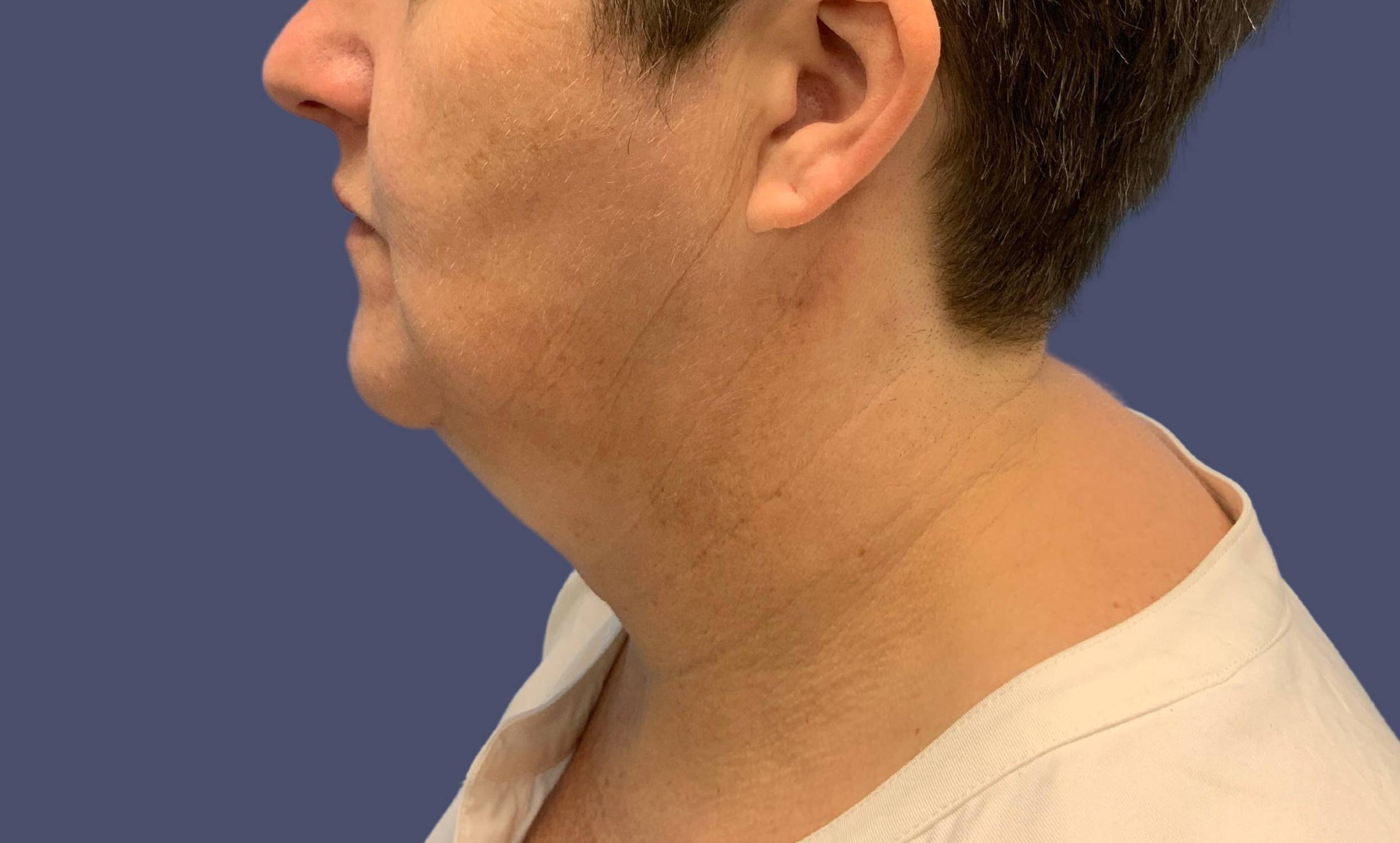 7 - Necklift Before