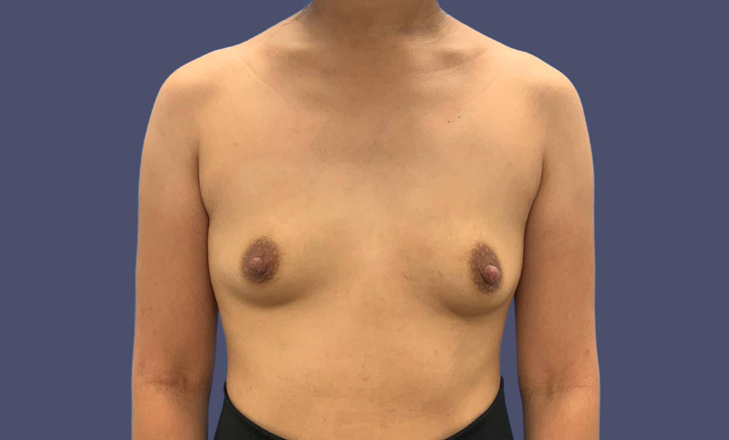 Breast Augmentation 14 Before