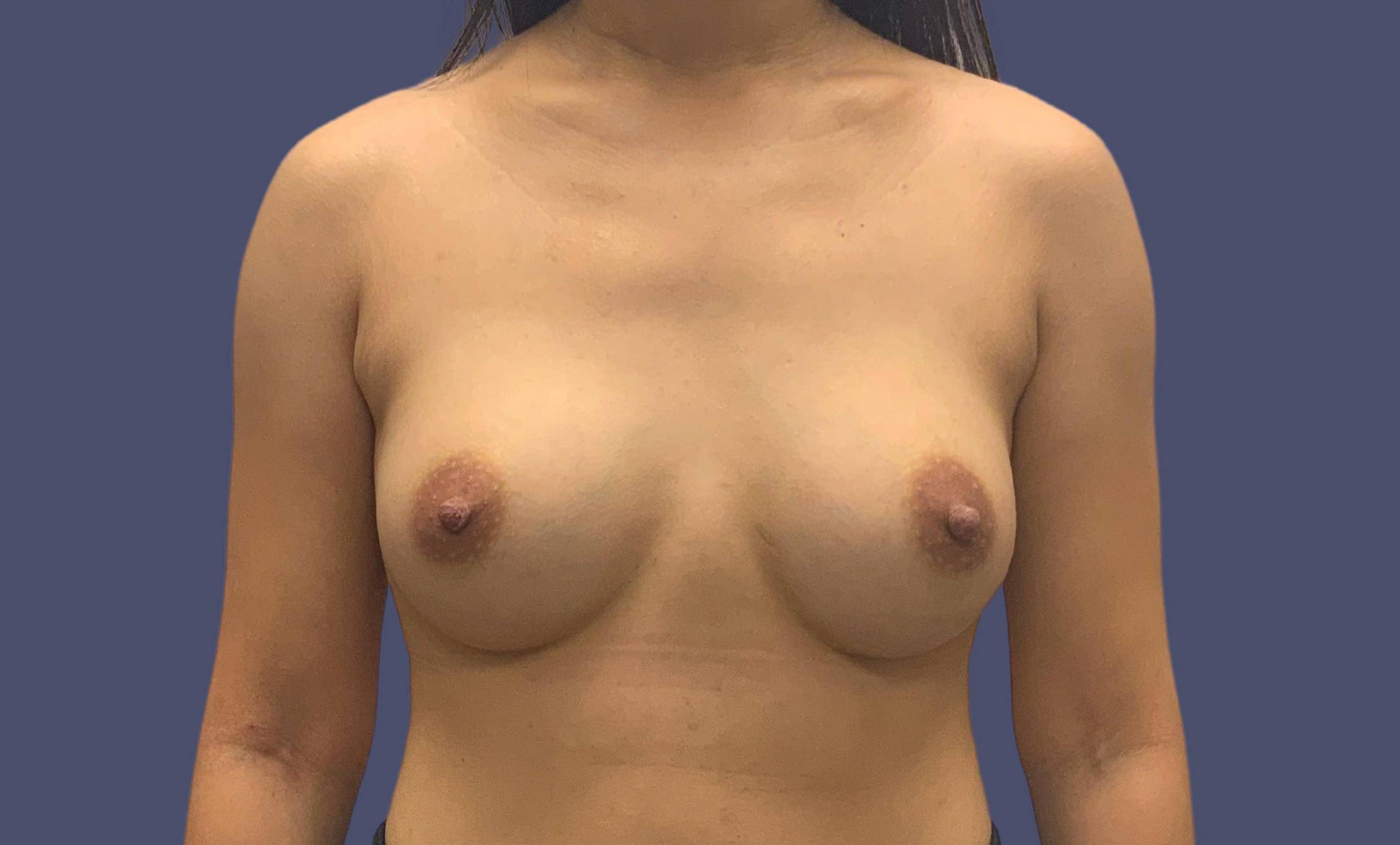 Breast Augmentation 14 After
