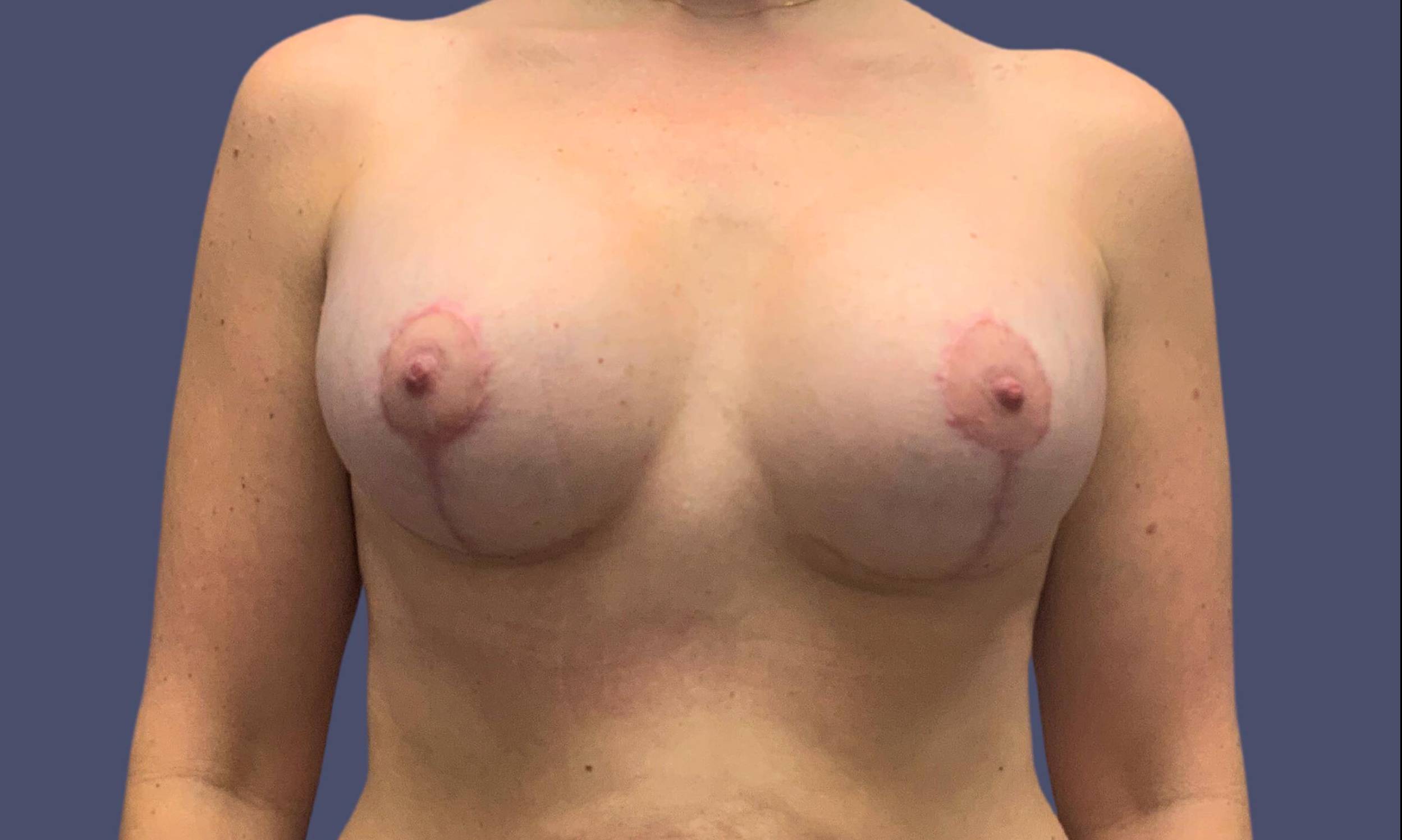 Breast Reduction with Augmentation 3 After