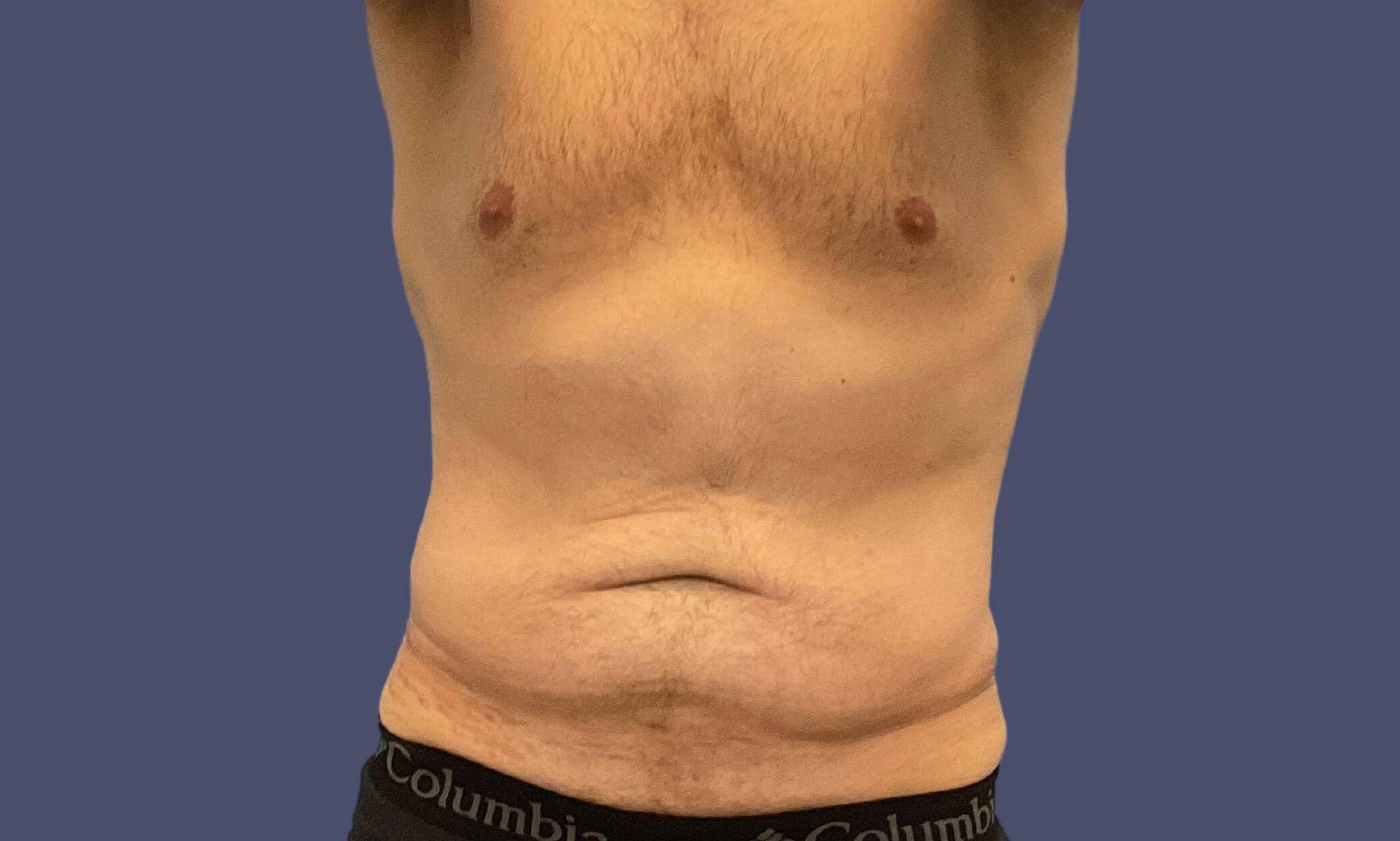 Abdominoplasty (Tummy Tuck) 27 Before