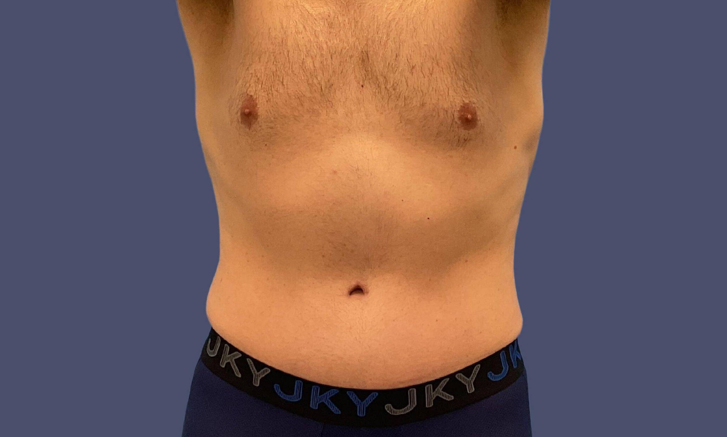 Abdominoplasty (Tummy Tuck) 32 After