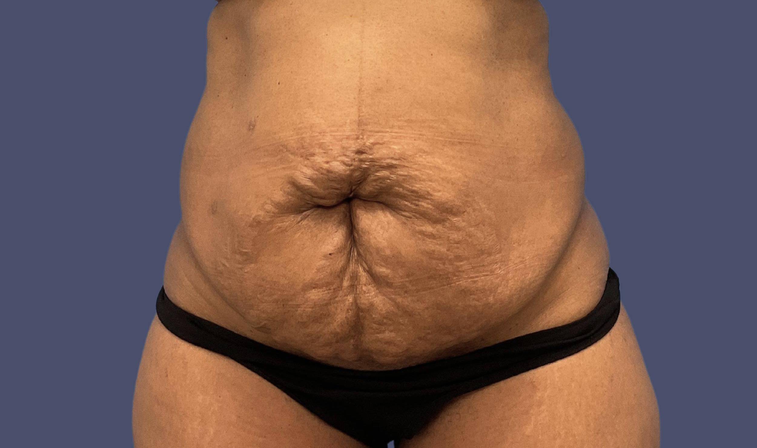 Abdominoplasty (Tummy Tuck) 16 Before
