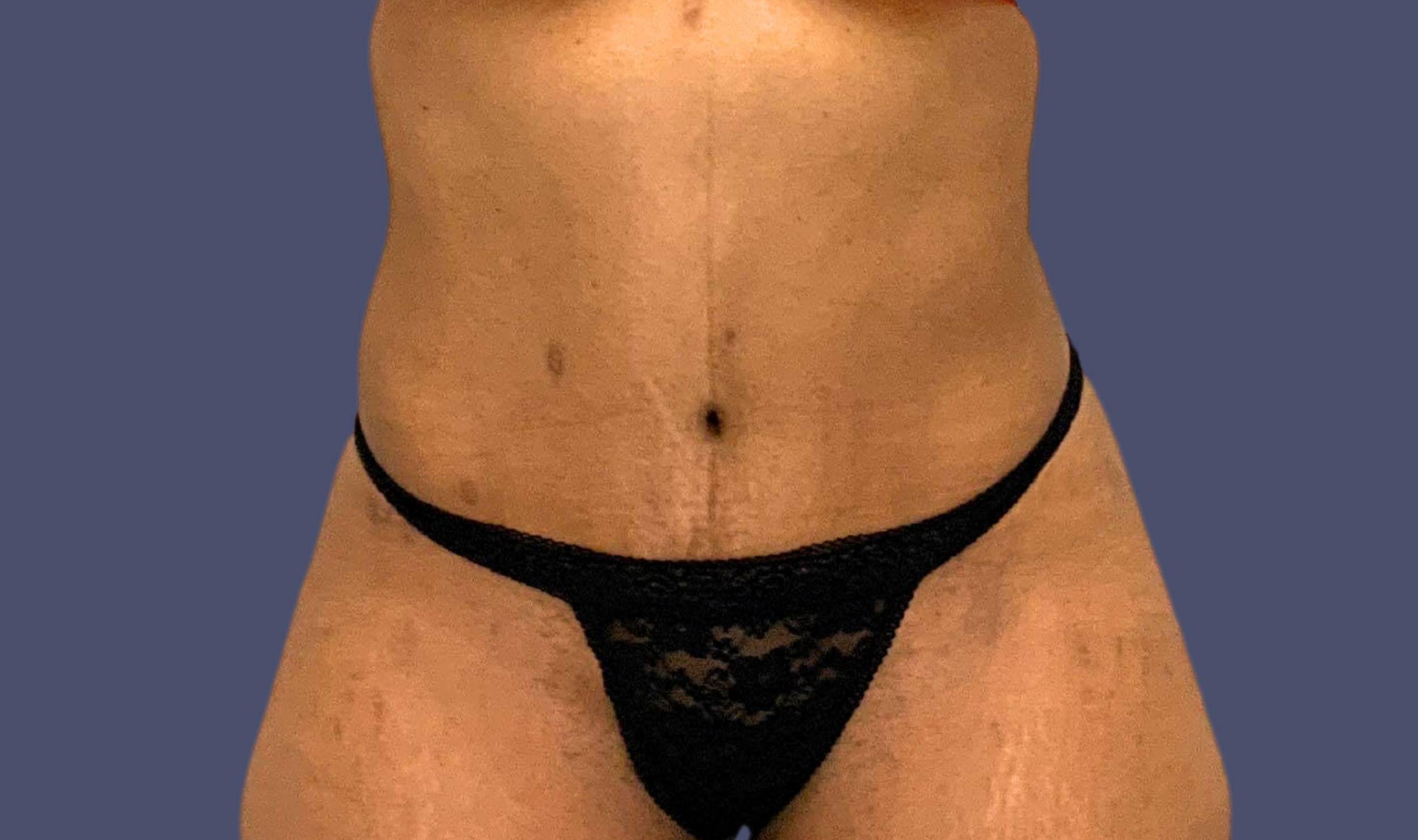Abdominoplasty (Tummy Tuck) 16 After