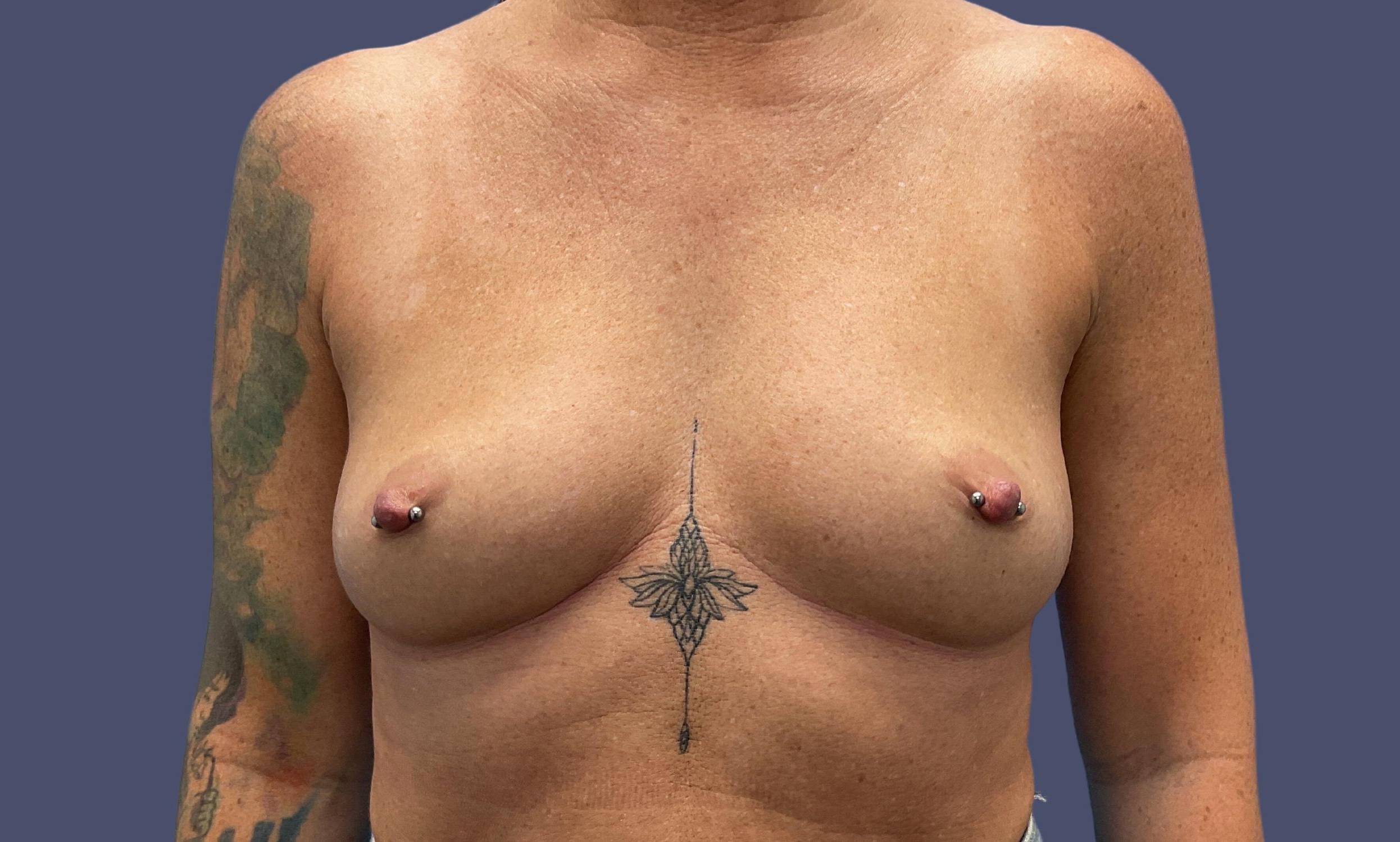 Breast Augmentation 42 Before