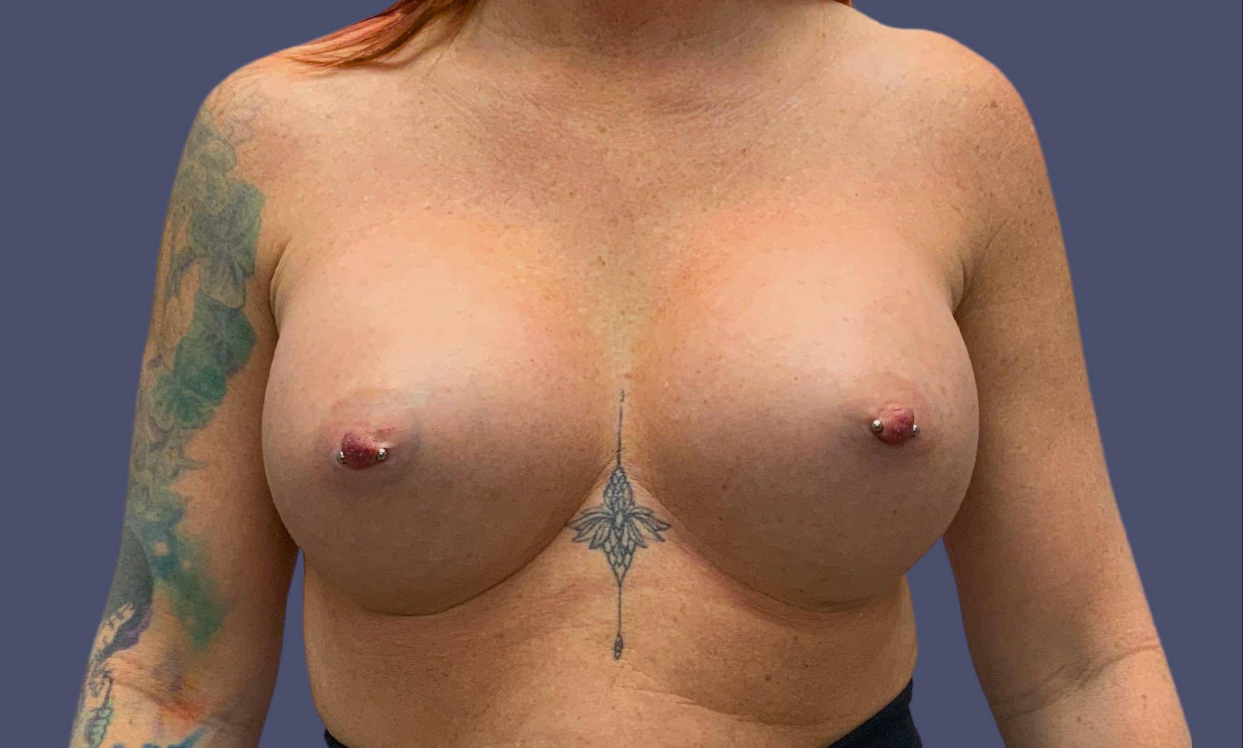 Breast Augmentation 42 After