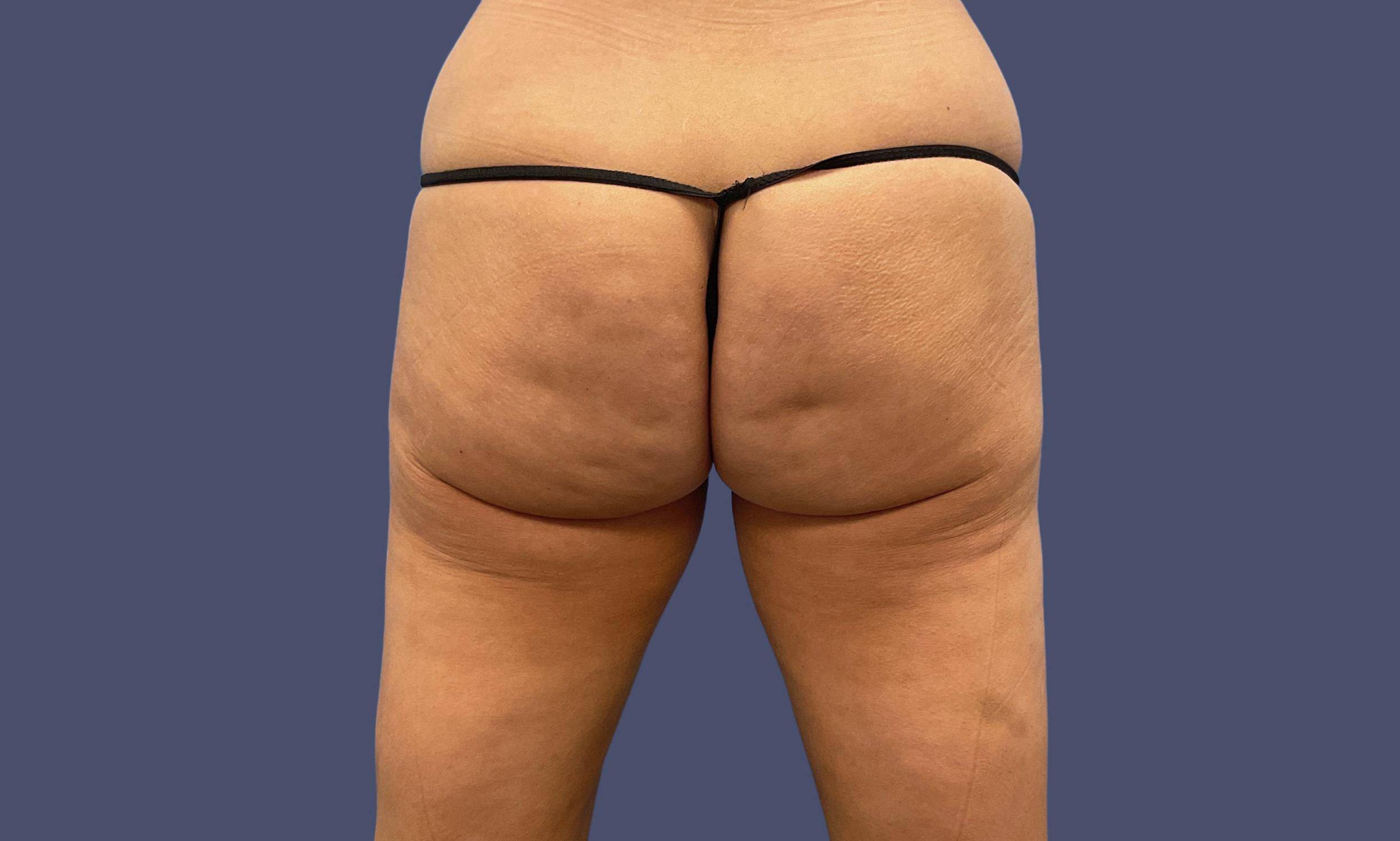 Avéli Cellulite Treatment 1 Before