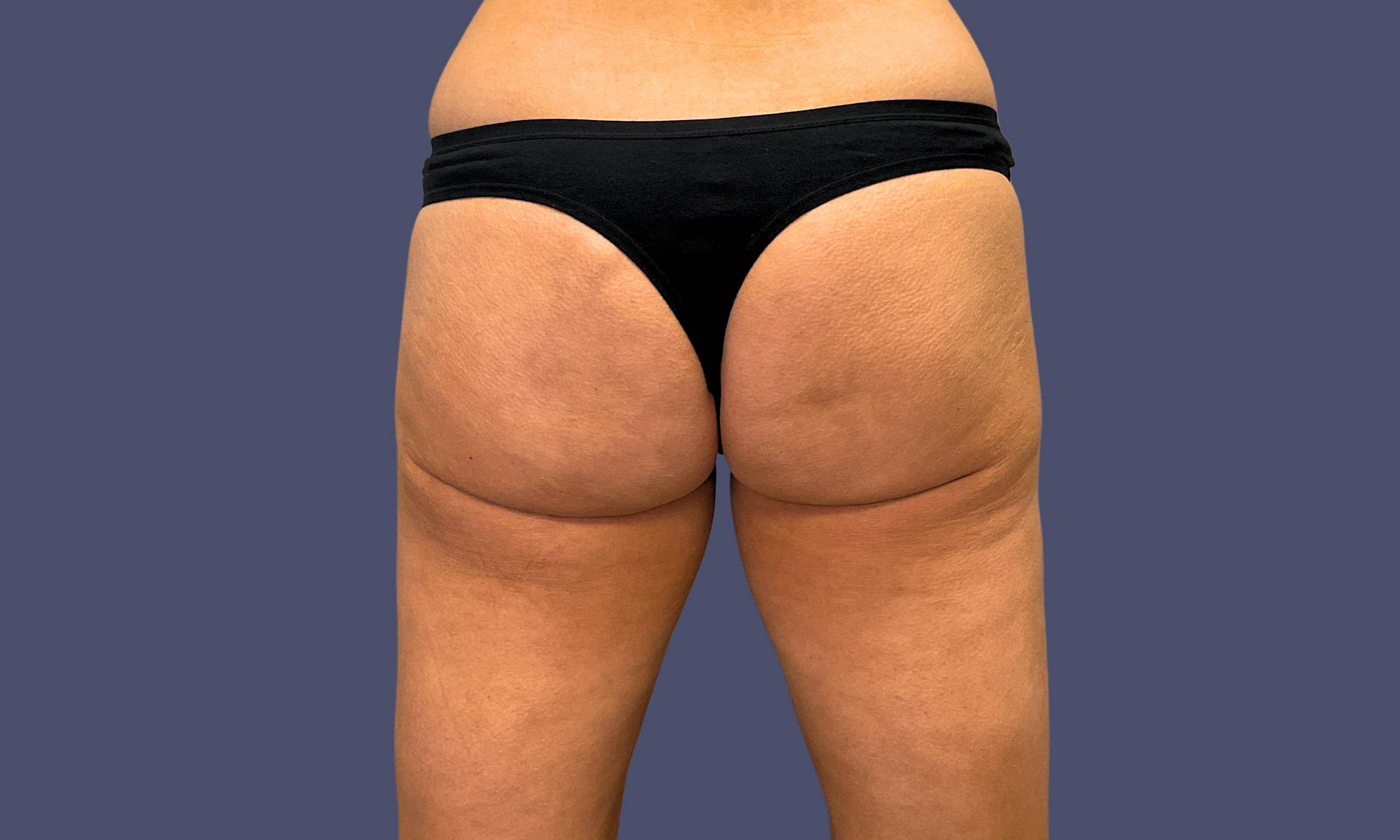 Avéli Cellulite Treatment 1 After