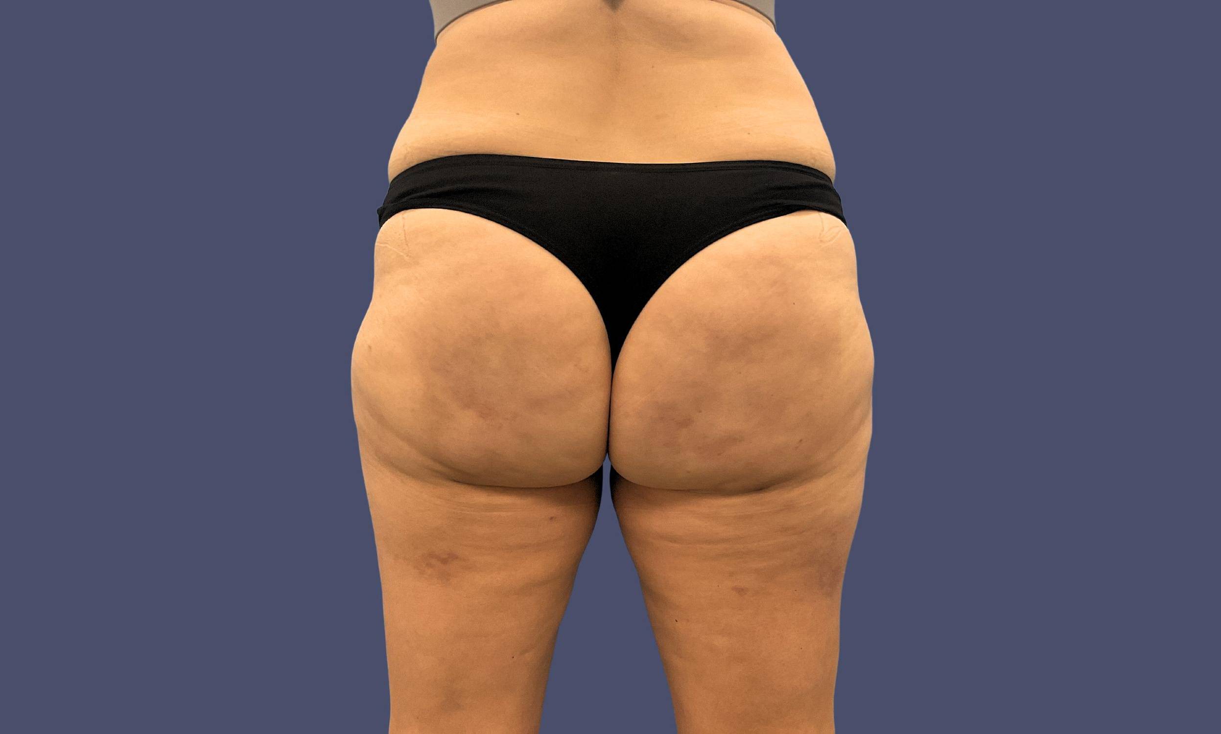 Avéli Cellulite Treatment 2 After