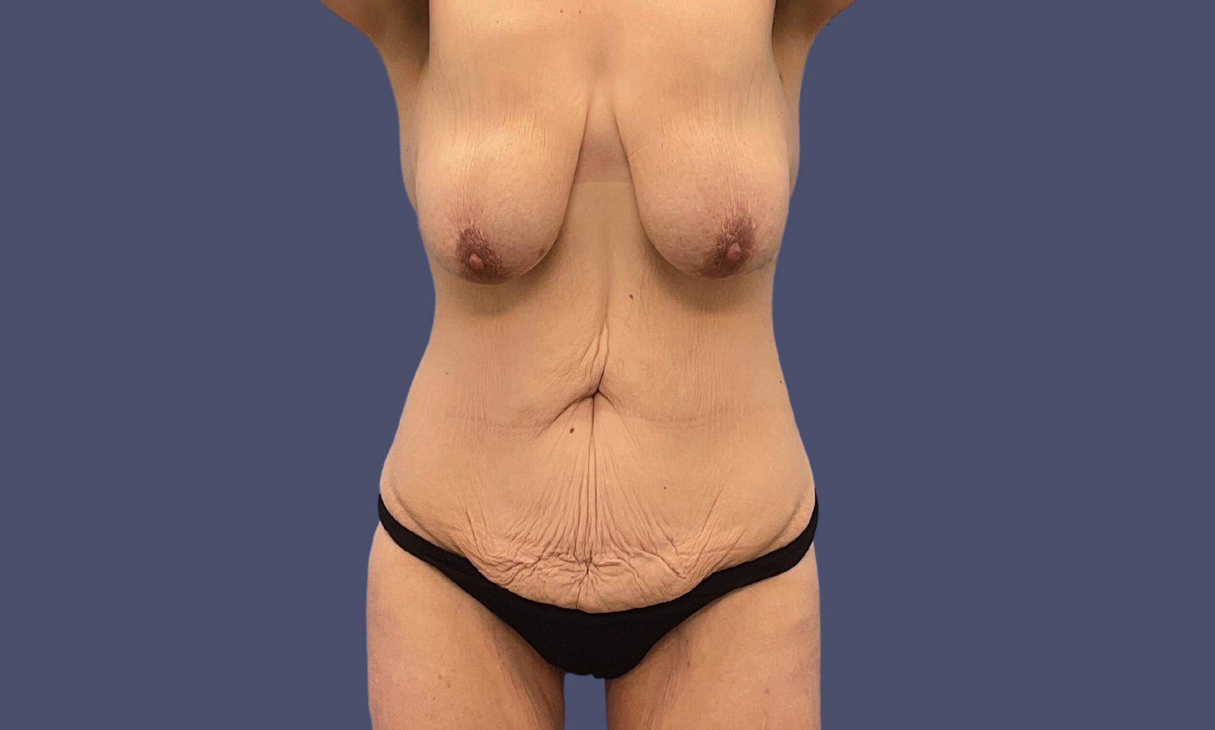 Post Weight Loss 4 Before