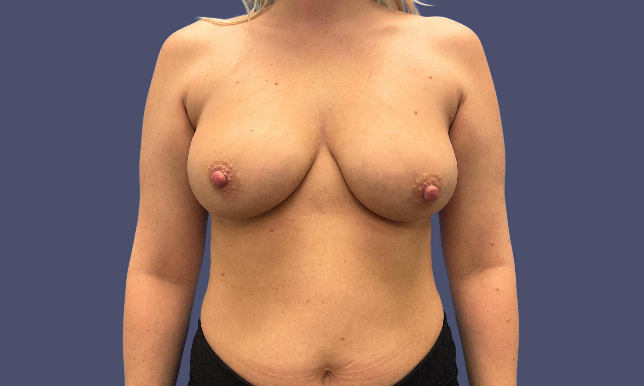 Breast Lift w/ Augmentation 5 Before