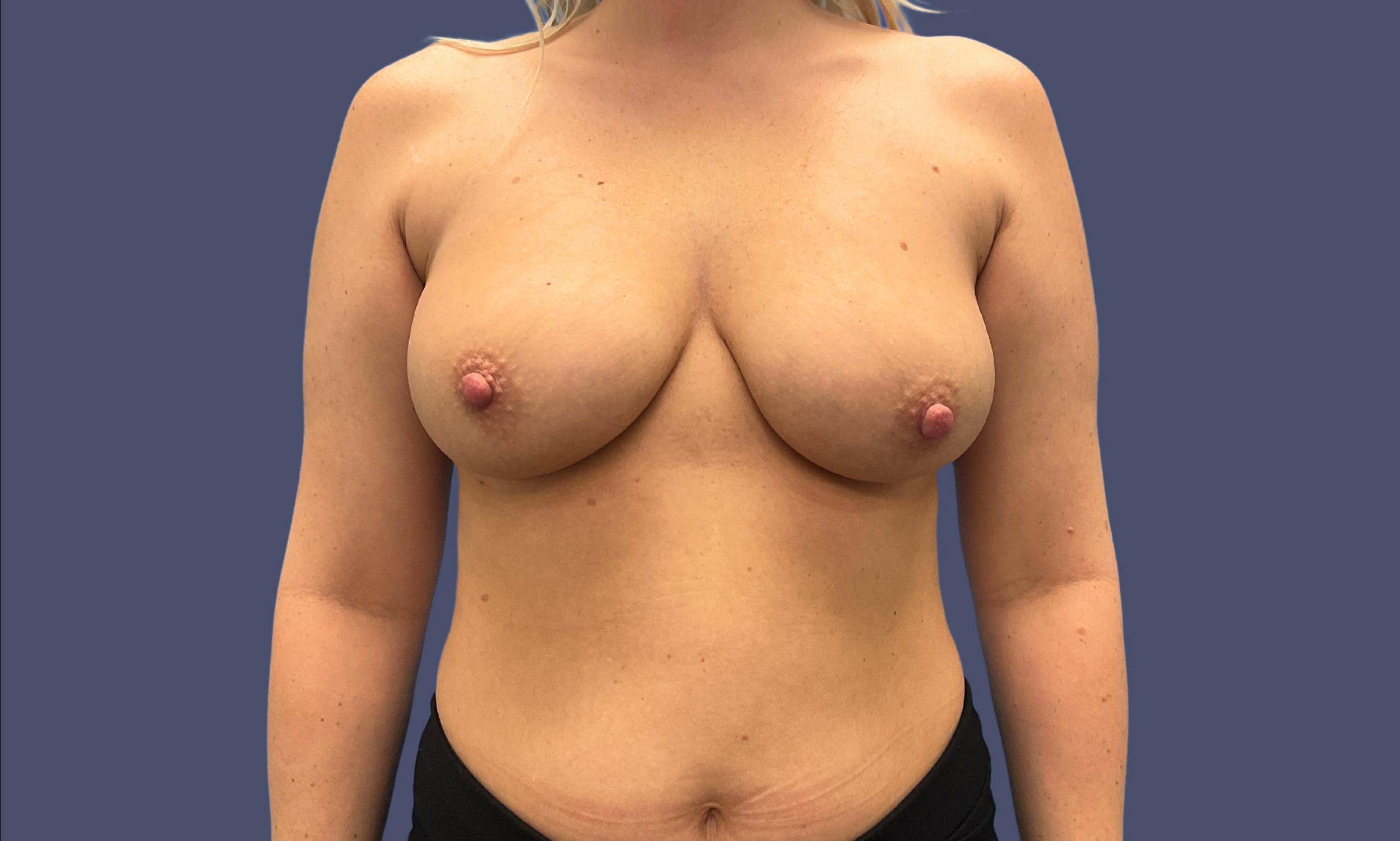 Breast Lift w/ Augmentation 7 Before