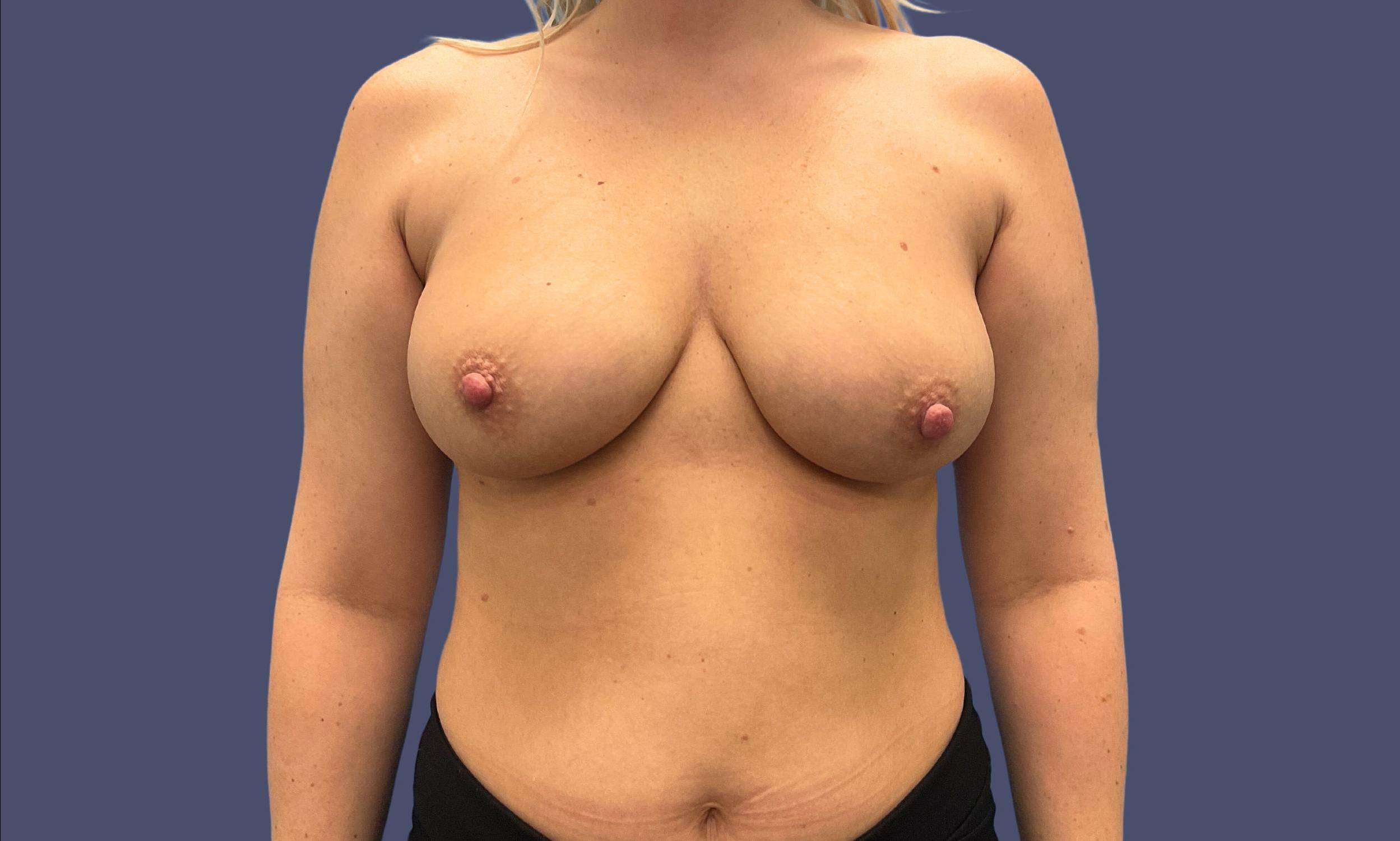 Breast Lift w/ Augmentation 8 Before