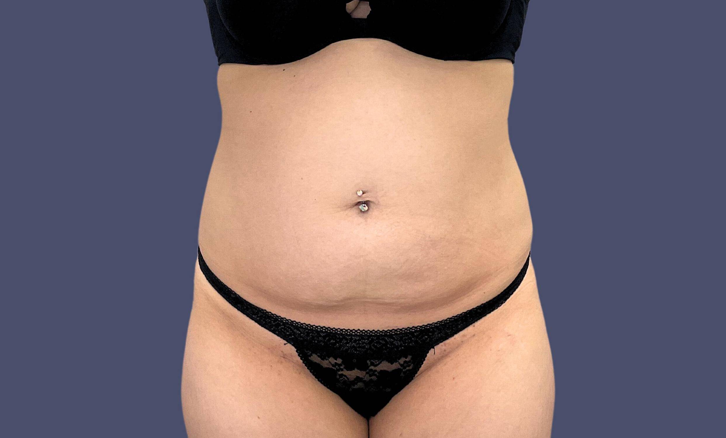 Abdominoplasty (Tummy Tuck) 30 Before