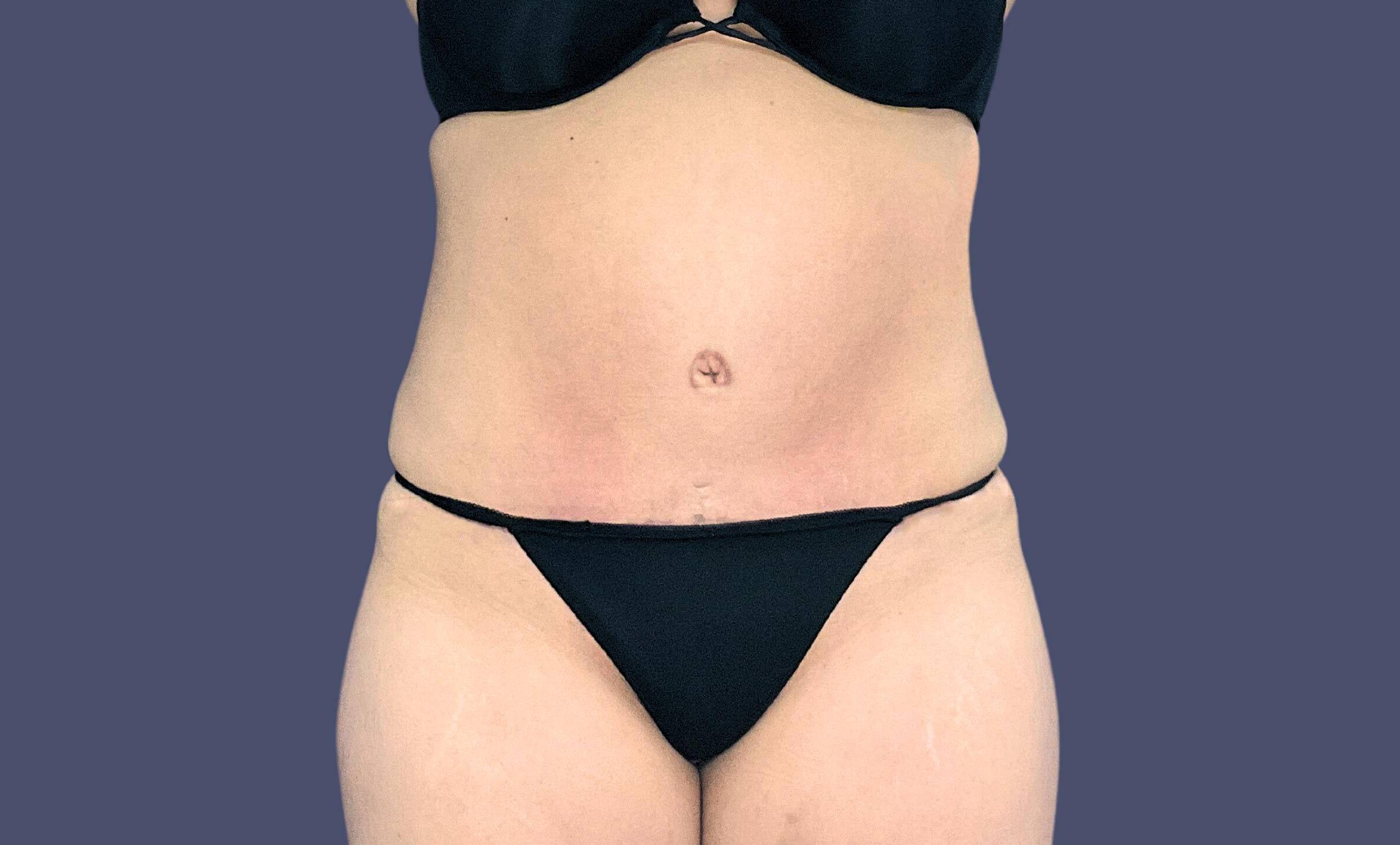 Abdominoplasty (Tummy Tuck) 33 After