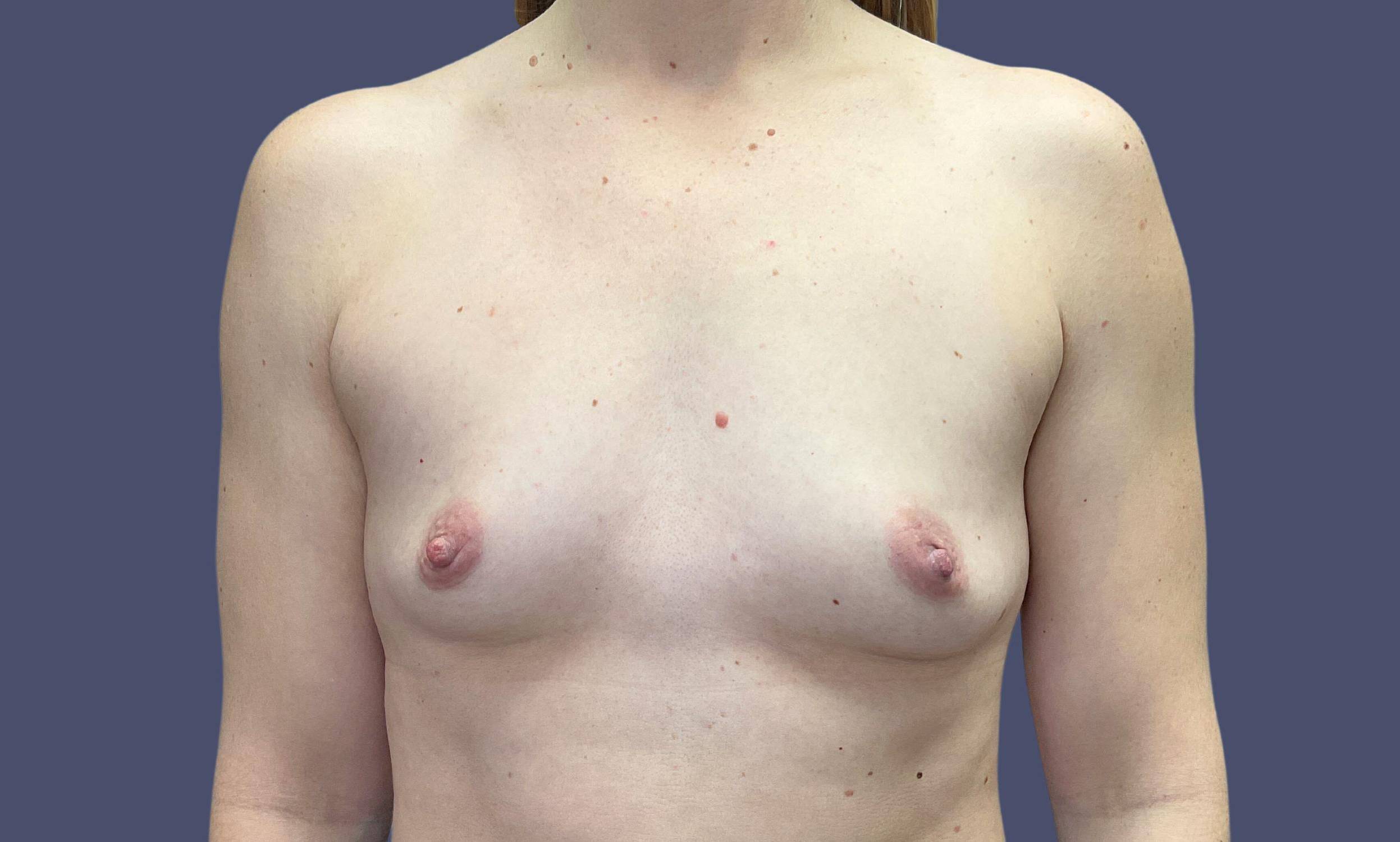 Breast Augmentation 32 Before