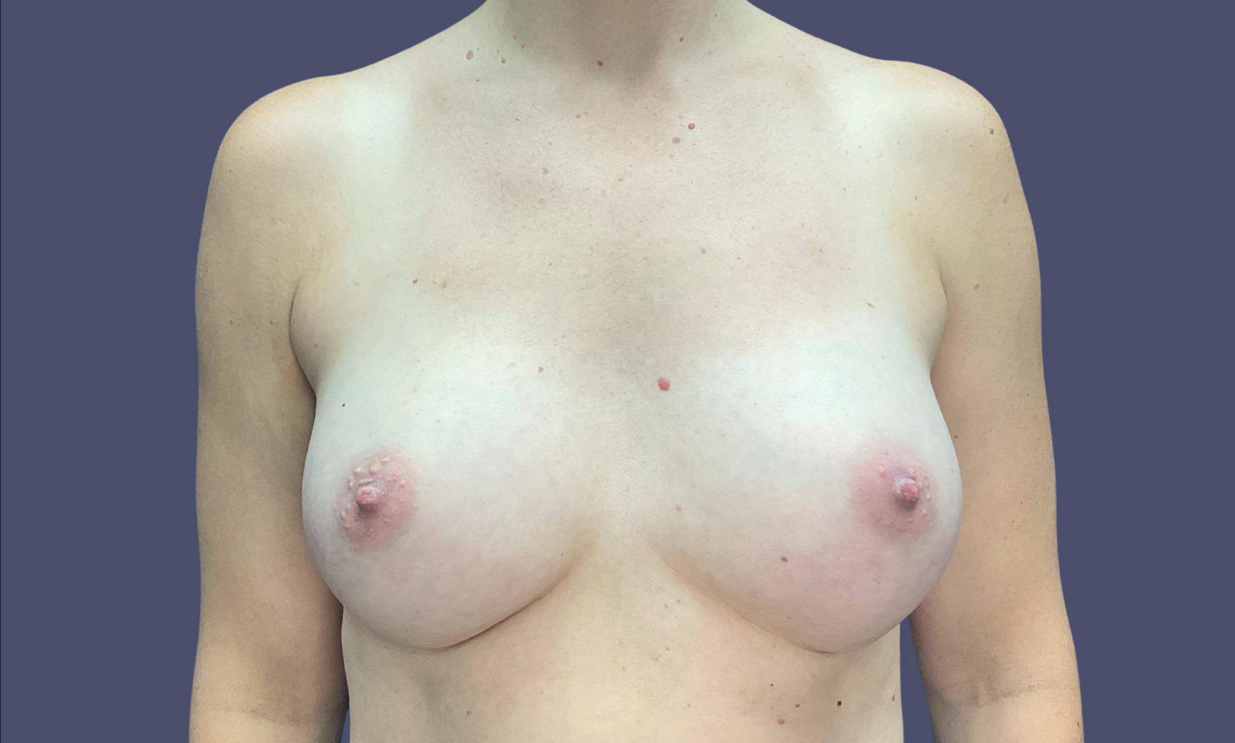 Breast Augmentation 24 After