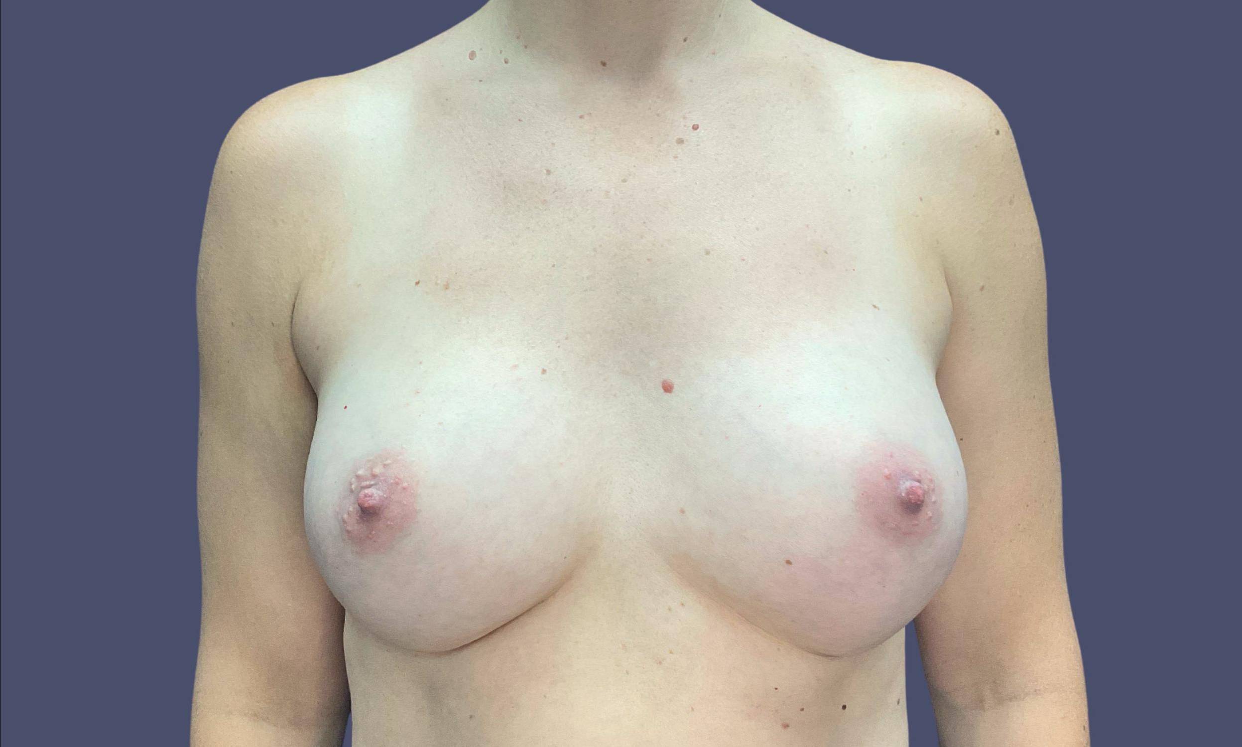 Breast Augmentation 36 After