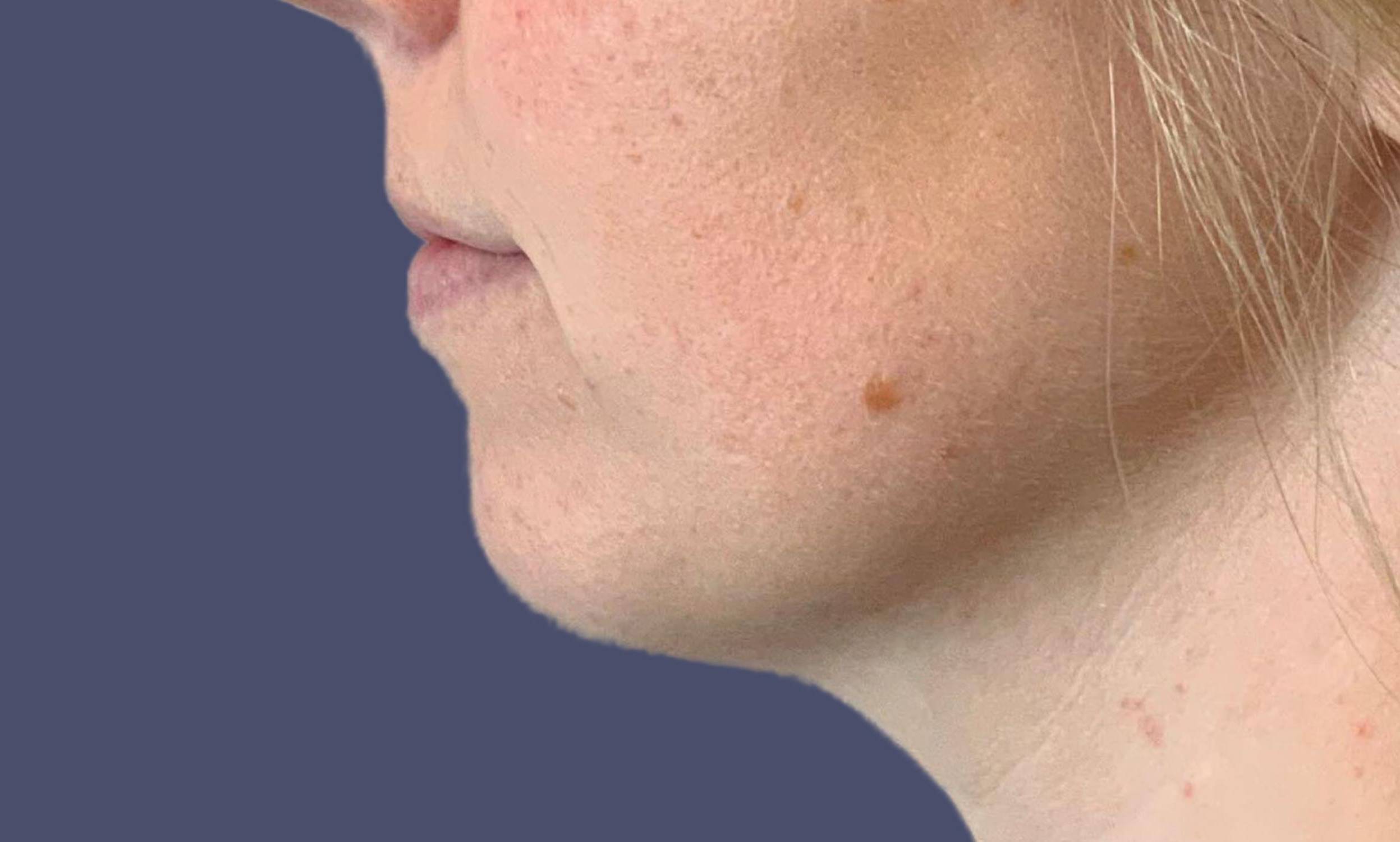 Dermal Filler 3 - Chin Before