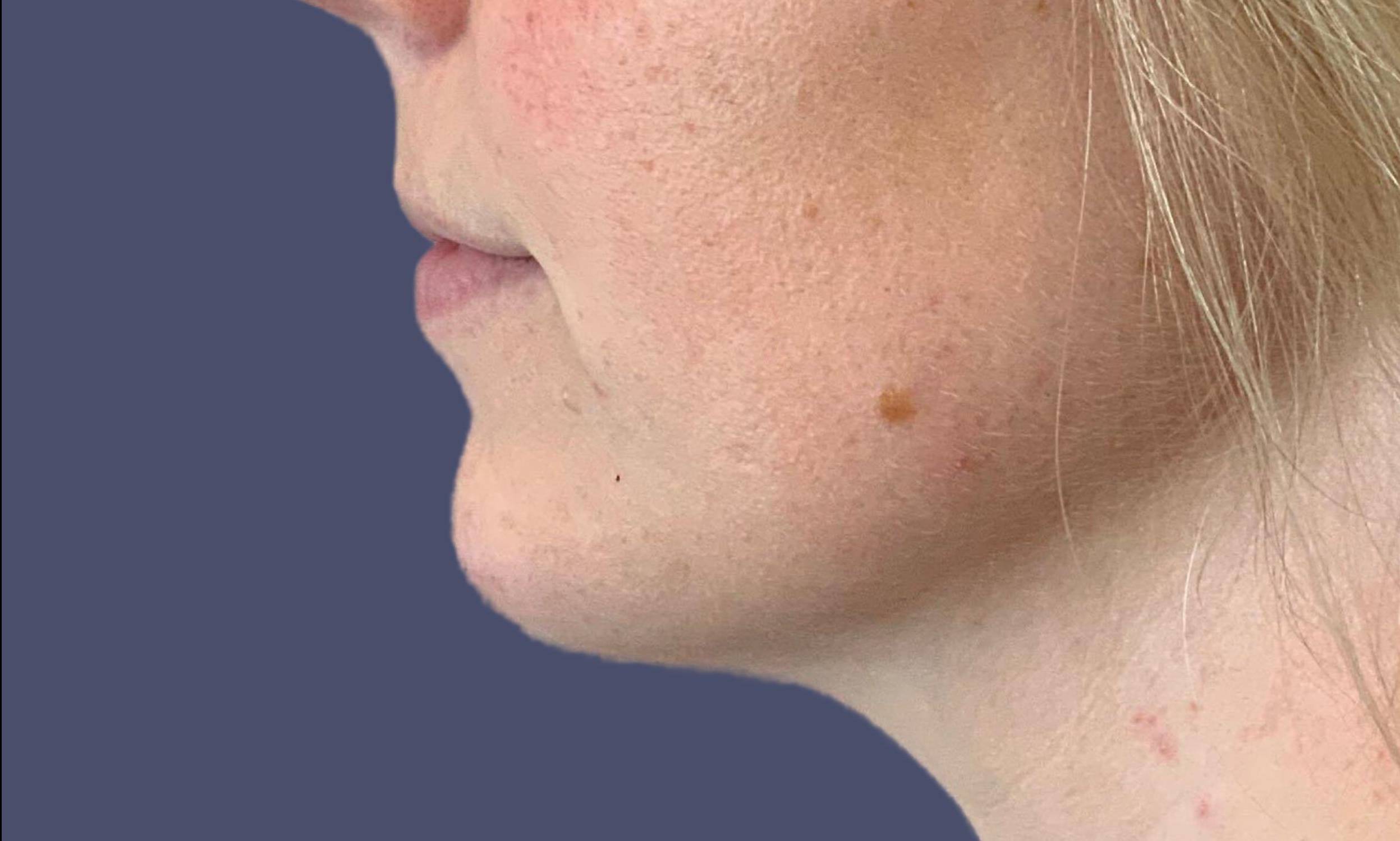 Dermal Filler 3 - Chin After