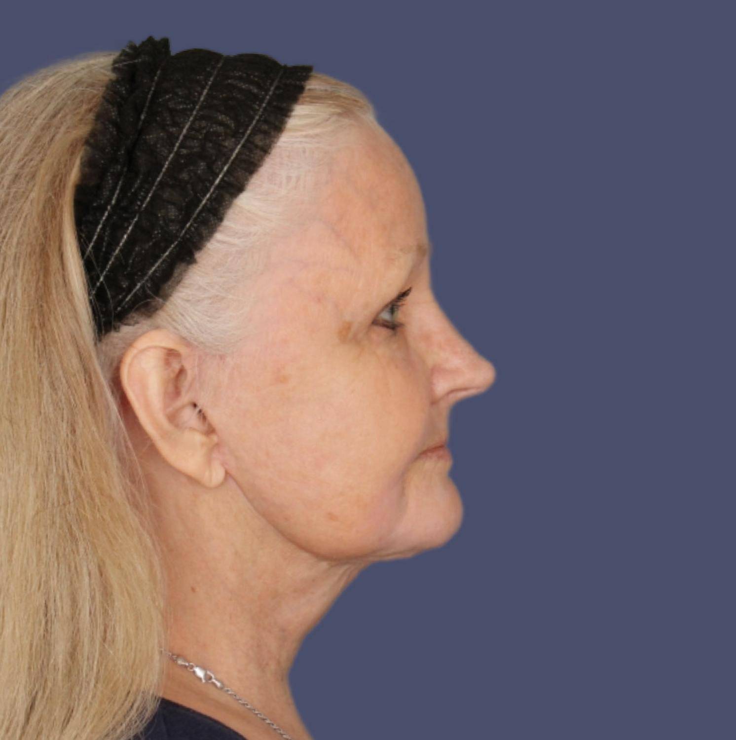 2 - Facelift & Necklift After