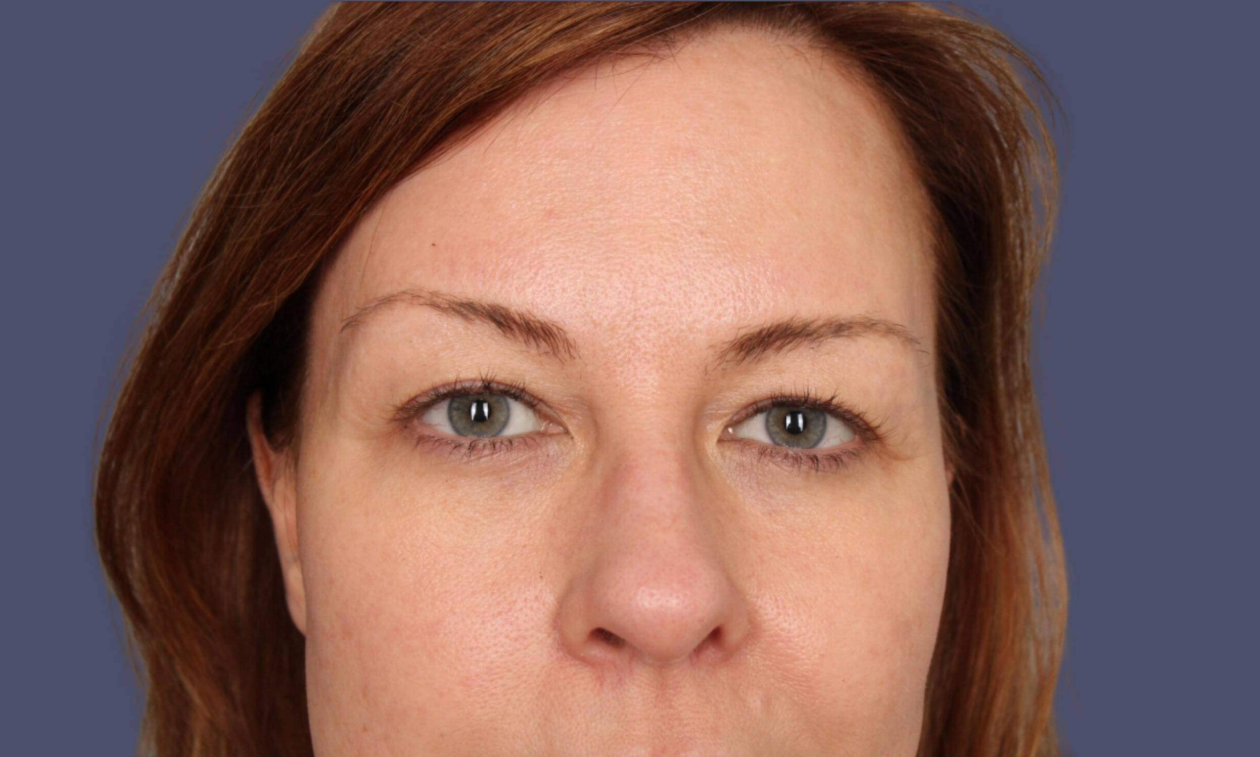 Blepharoplasty 9 - Upper Before