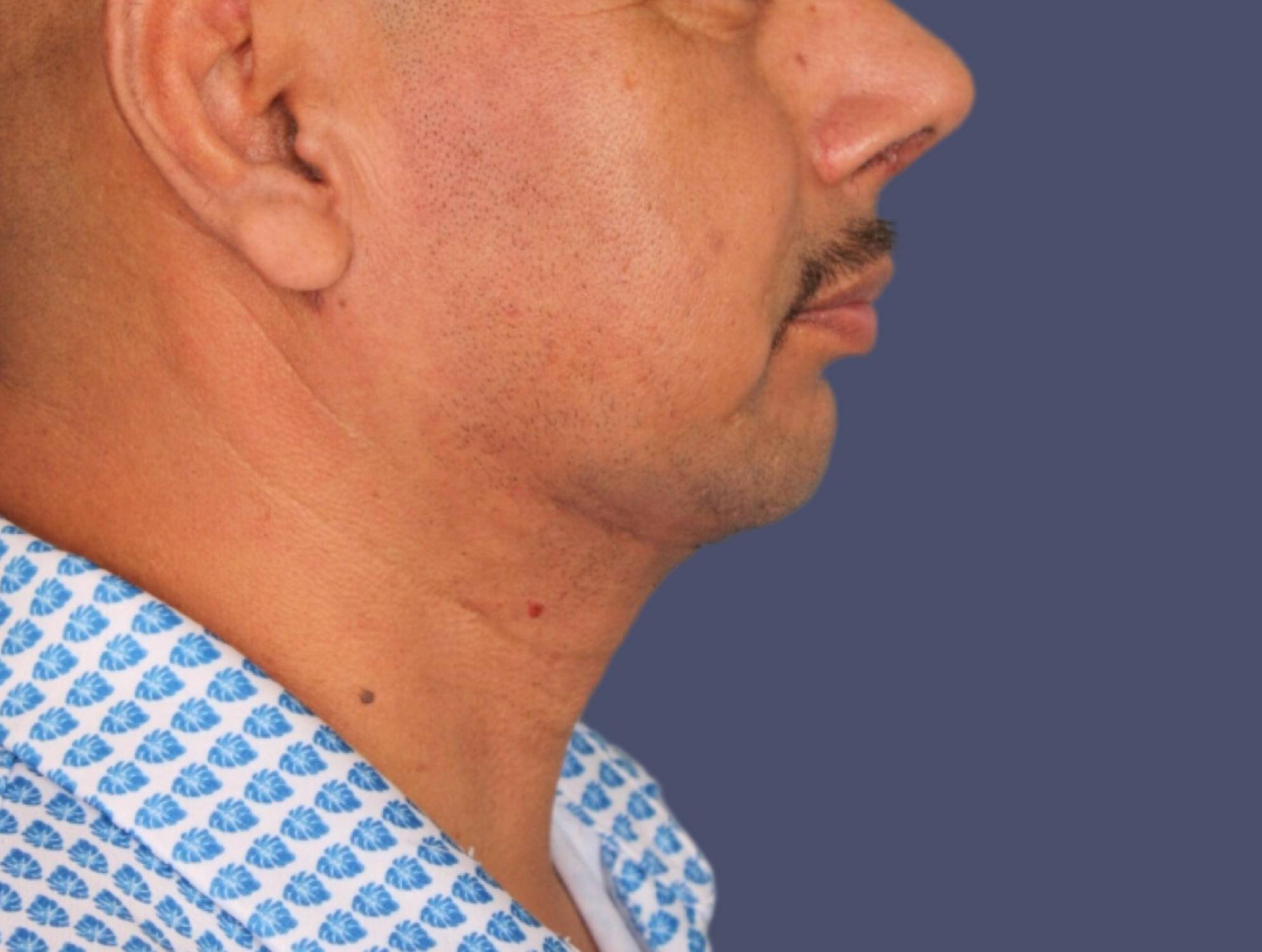 Liposuction 6 - Neck After