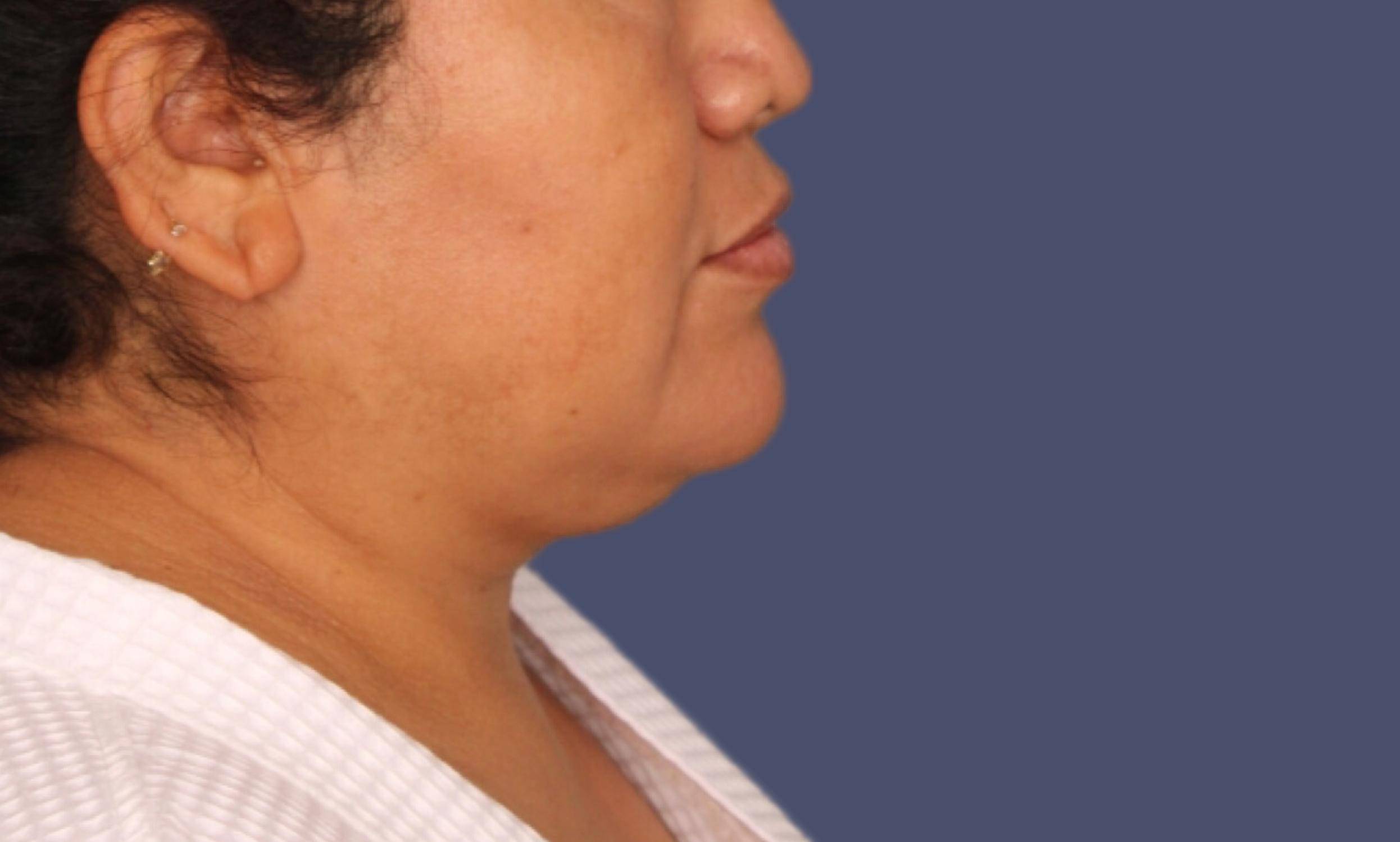 Submental Liposuction 7 Before