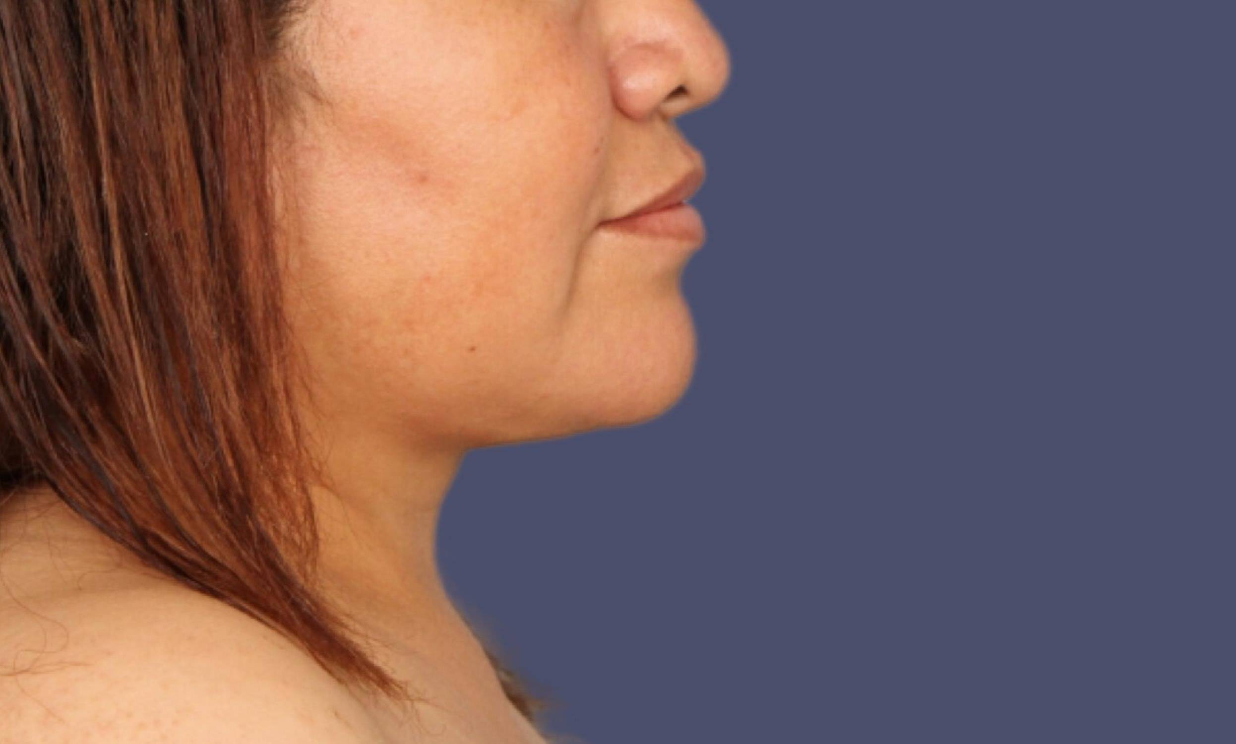Liposuction 5 - Neck After