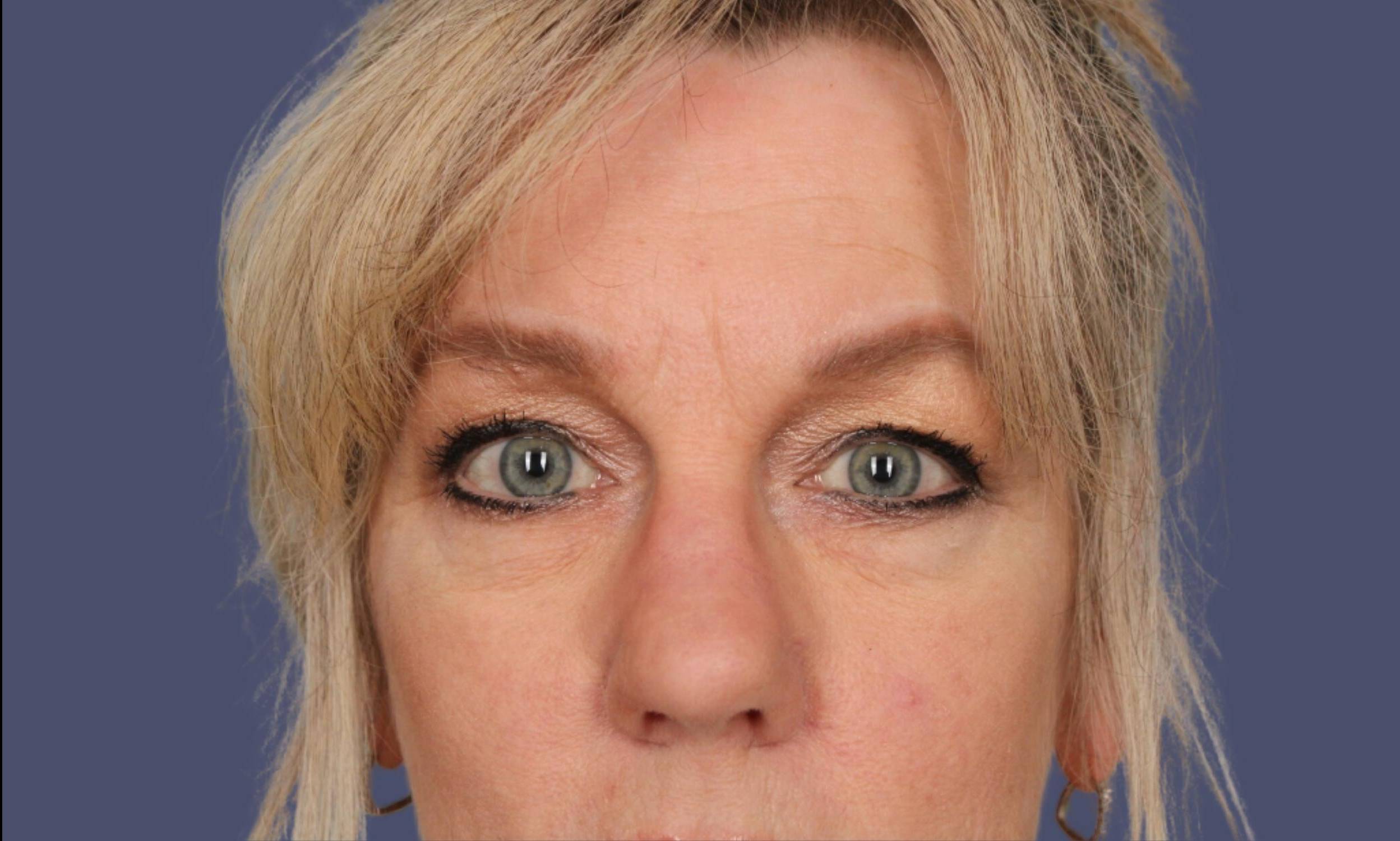 Blepharoplasty 8 - Upper Before