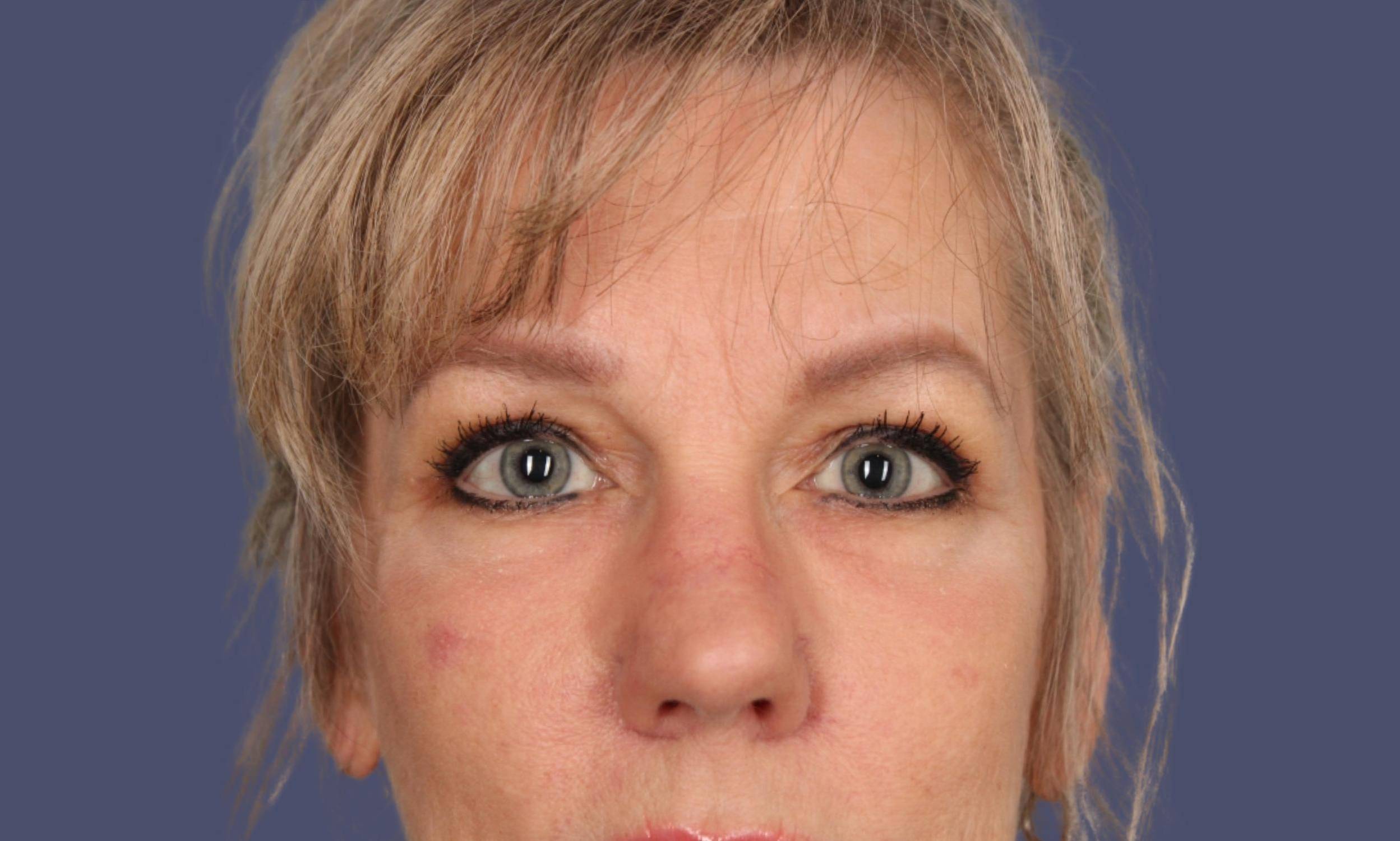 Blepharoplasty 8 - Upper After