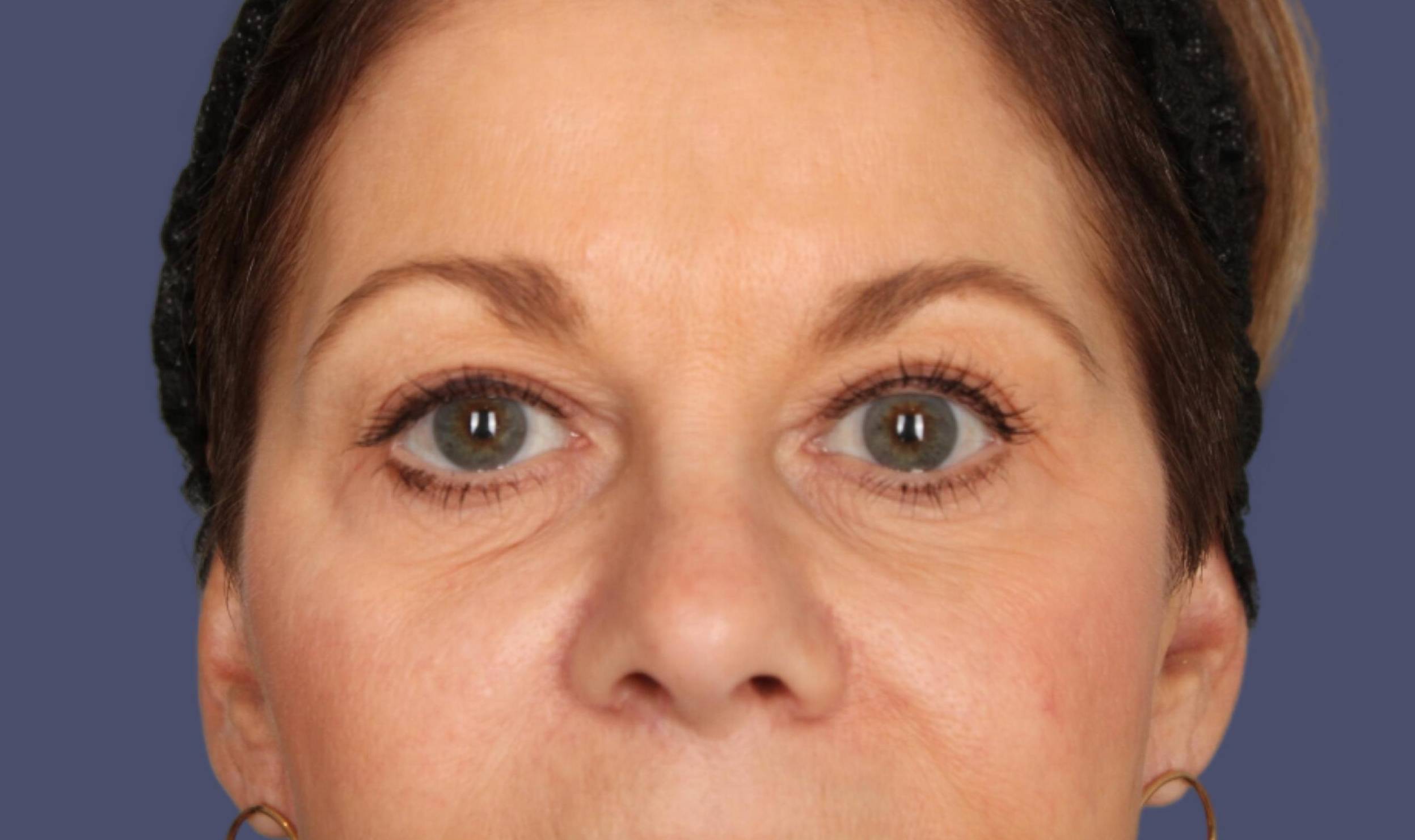 Blepharoplasty 16 - Upper Before