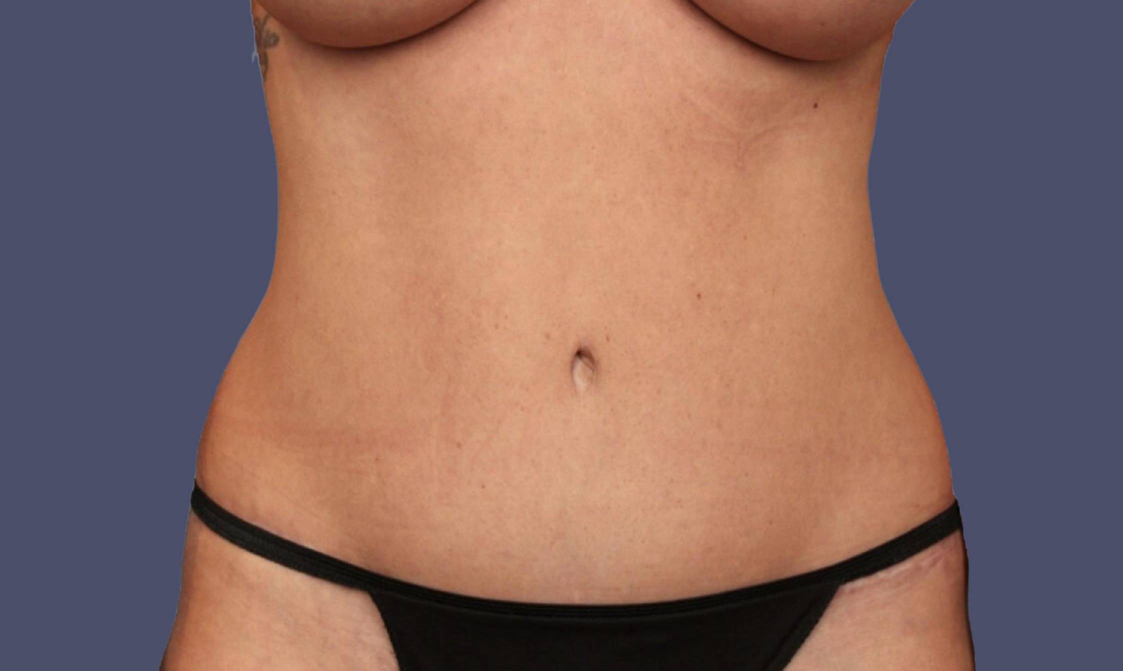 Abdominoplasty (Tummy Tuck) 2 After