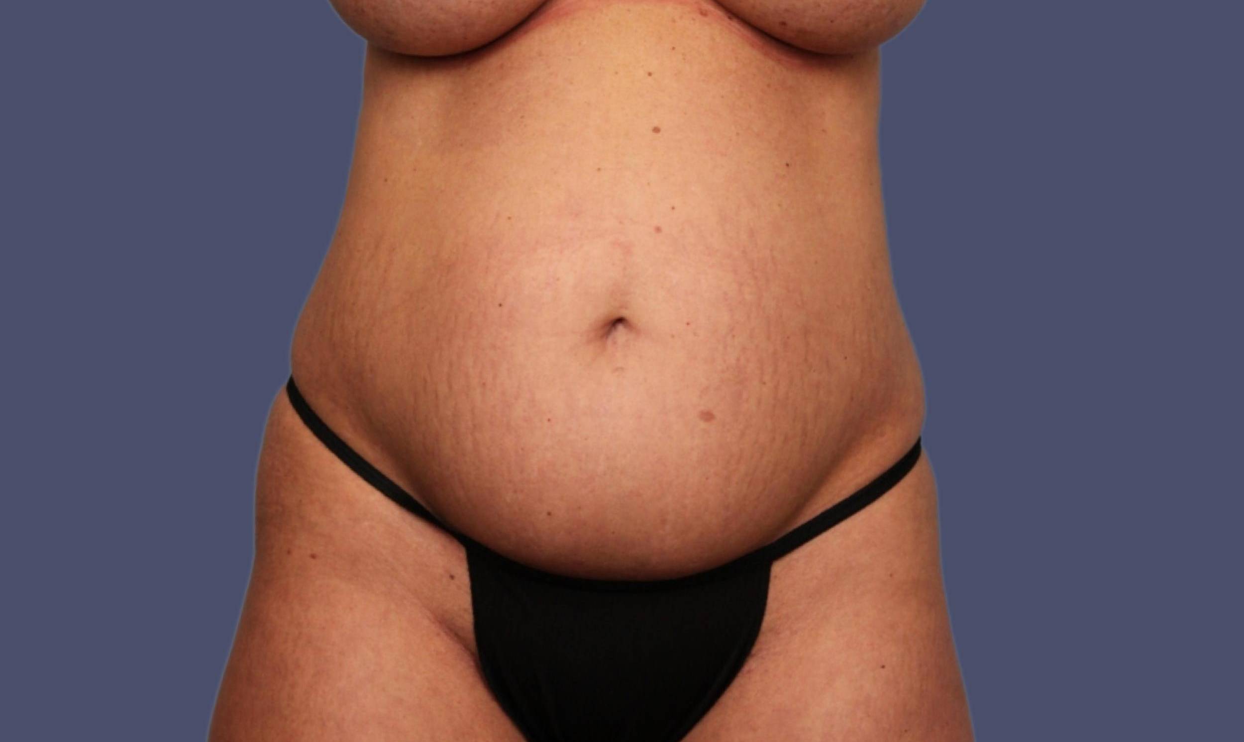 Abdominoplasty (Tummy Tuck) 16 Before