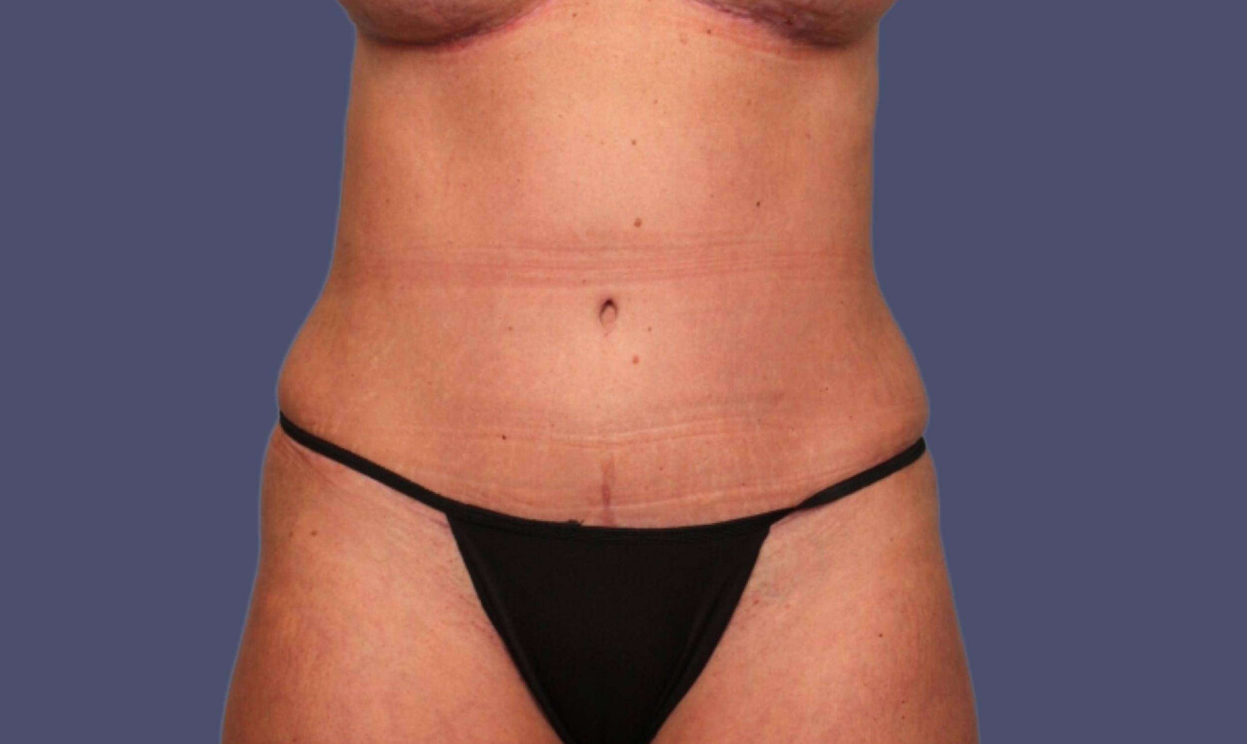Abdominoplasty (Tummy Tuck) 16 After