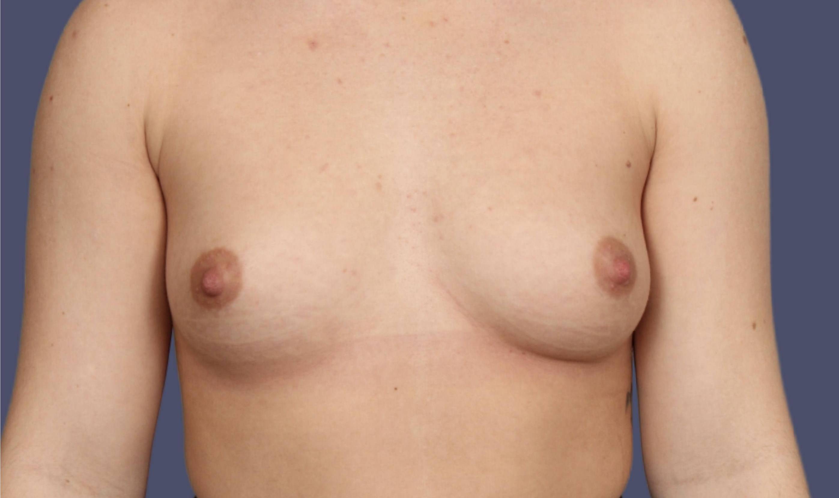 Breast Augmentation 32 Before