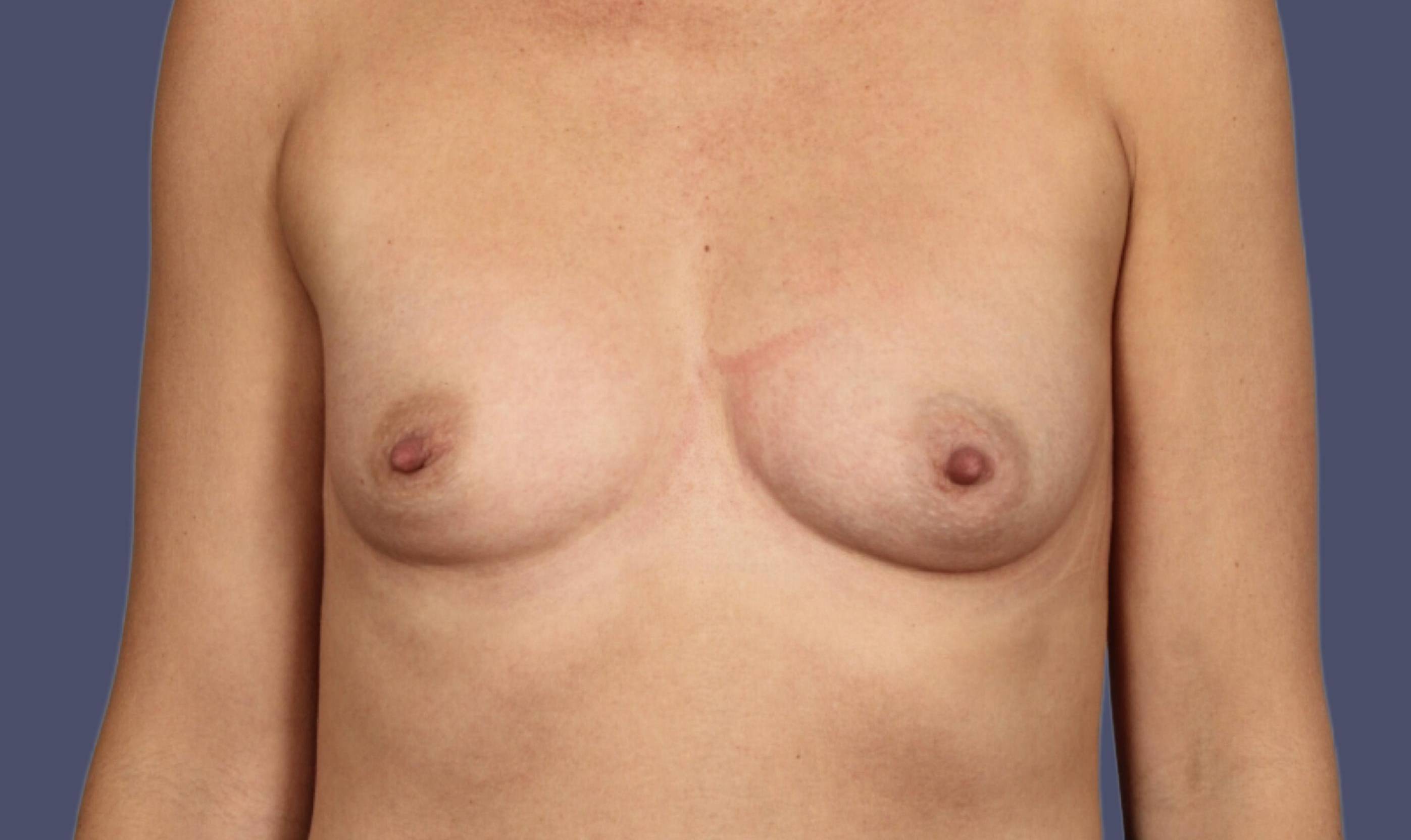 Breast Augmentation 44 Before