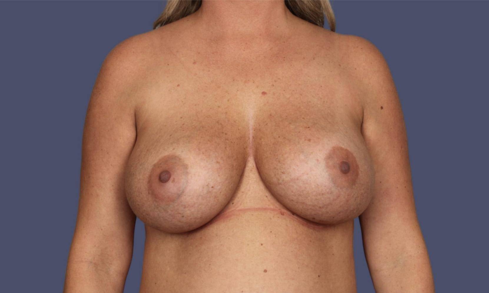 Breast Lift w/Augmentation 3 Before