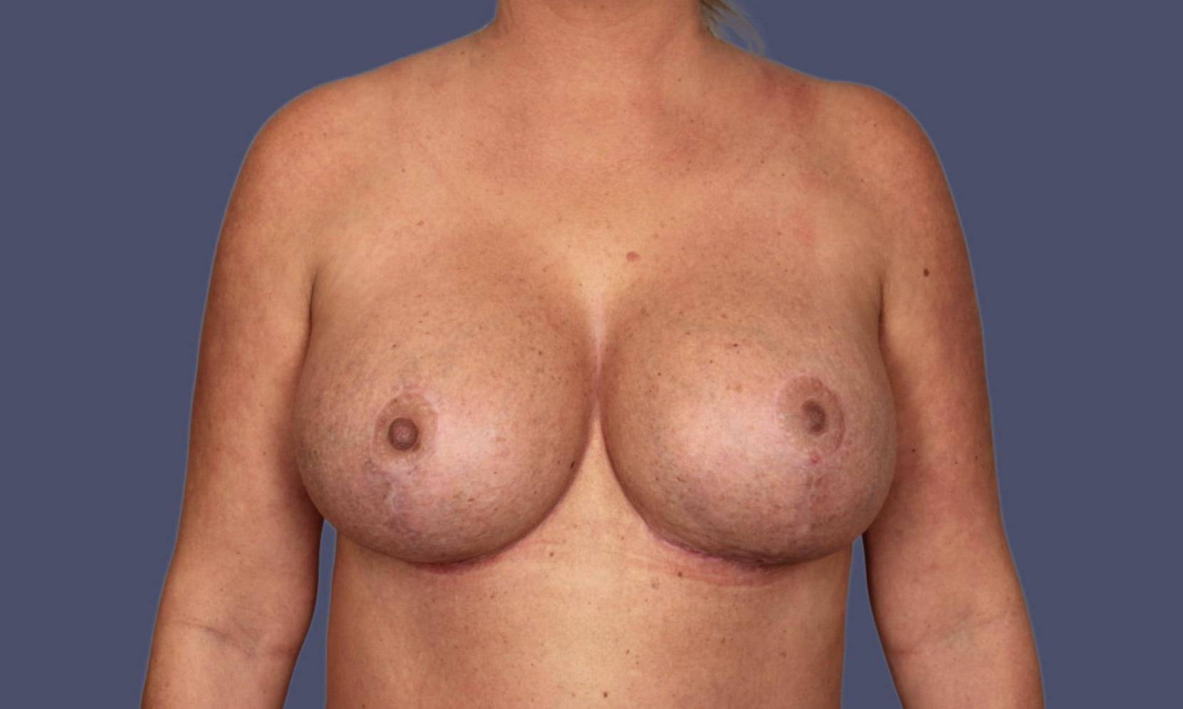 Breast Lift w/Augmentation 3 After