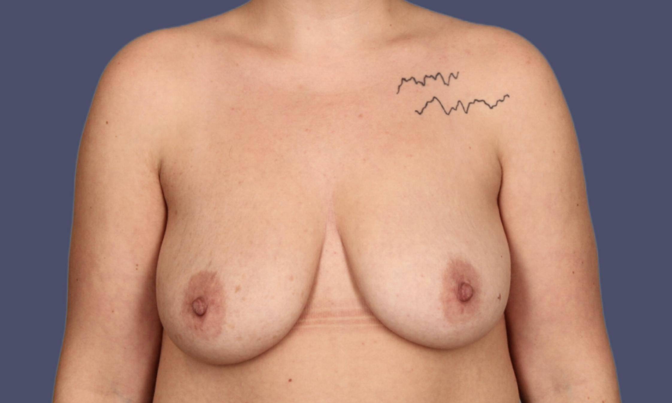 Breast Lift w/Augmentation 9 Before