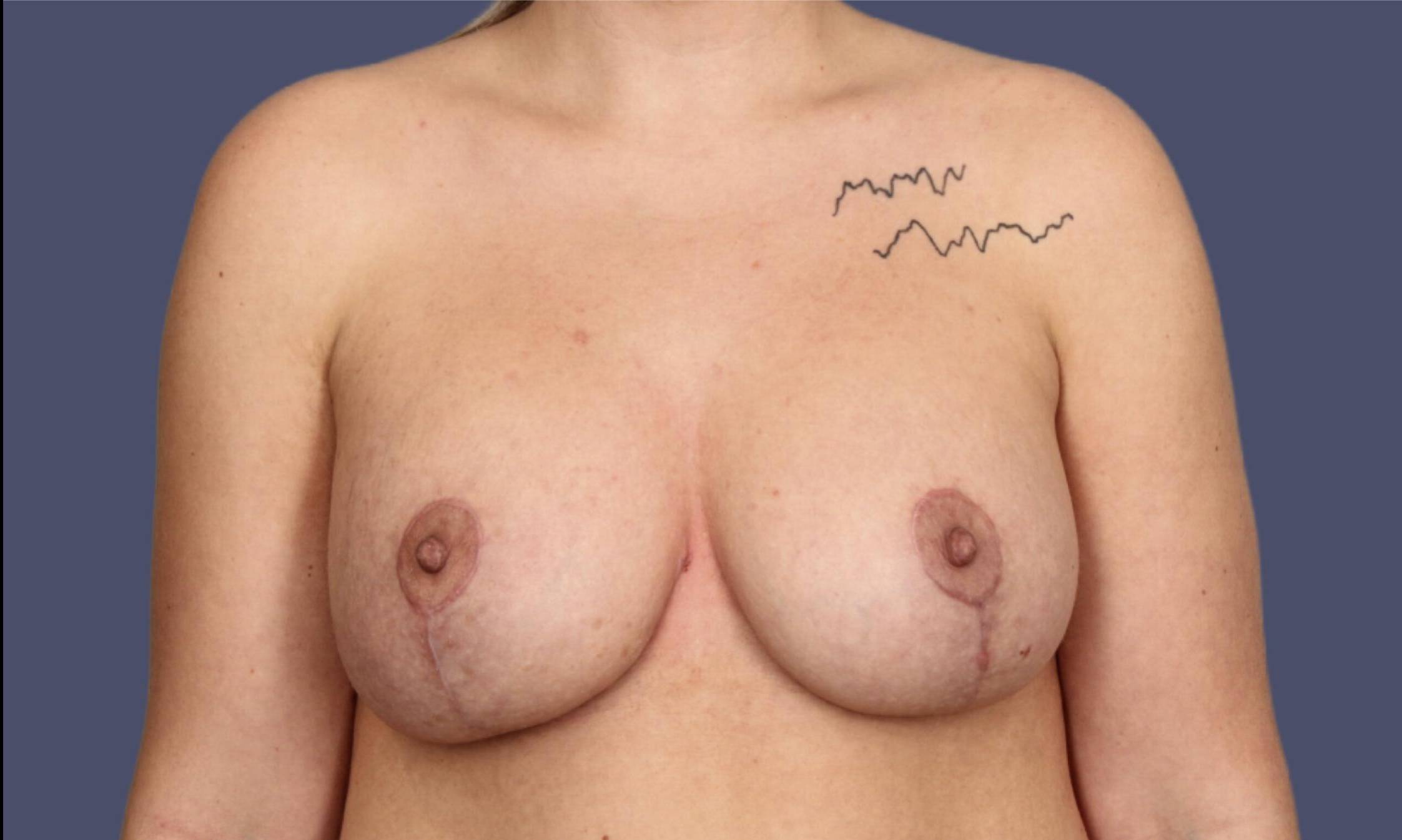 Breast Lift w/Augmentation 9 After