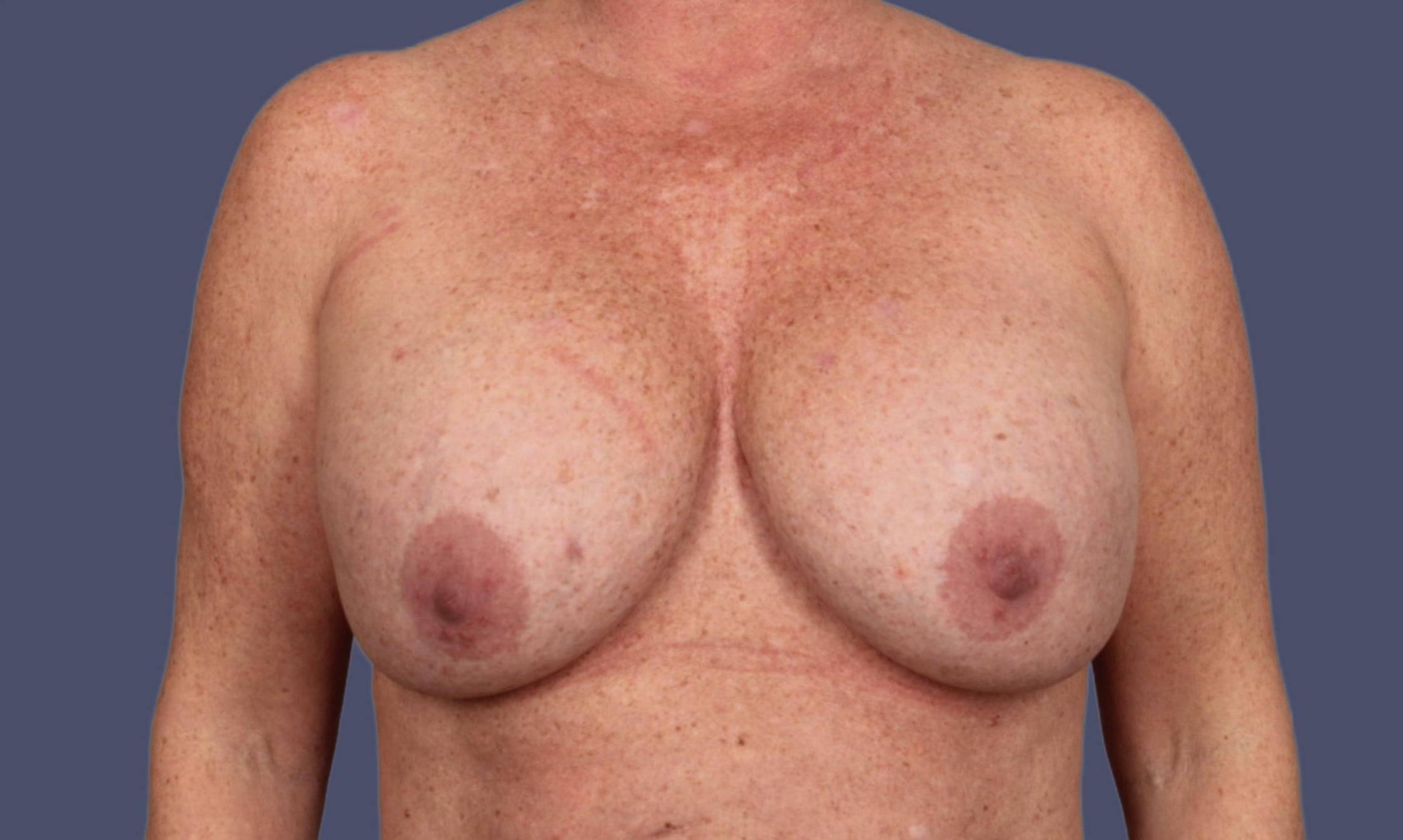 Breast Lift w/Augmentation 17 Before