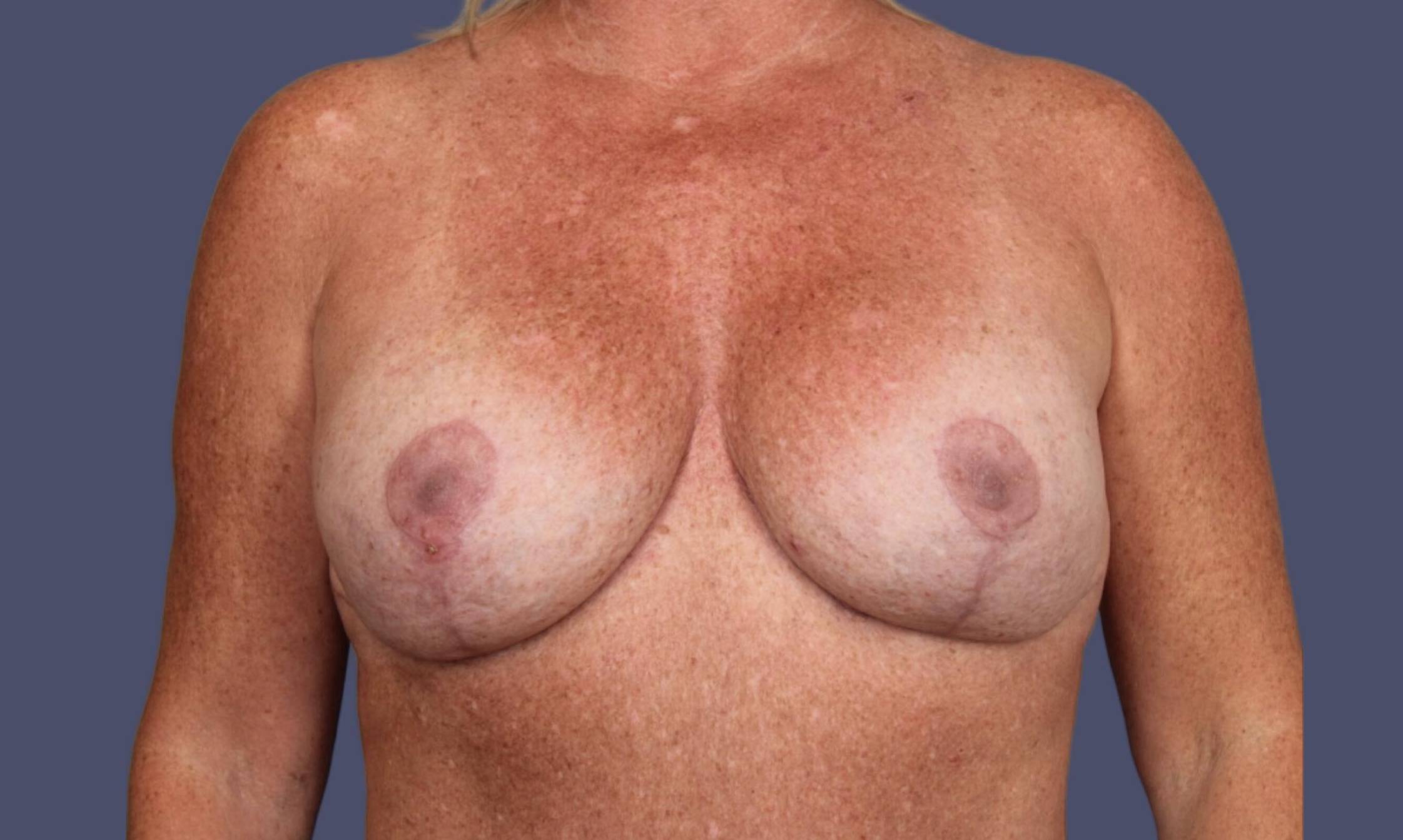 Breast Lift w/Augmentation 17 After